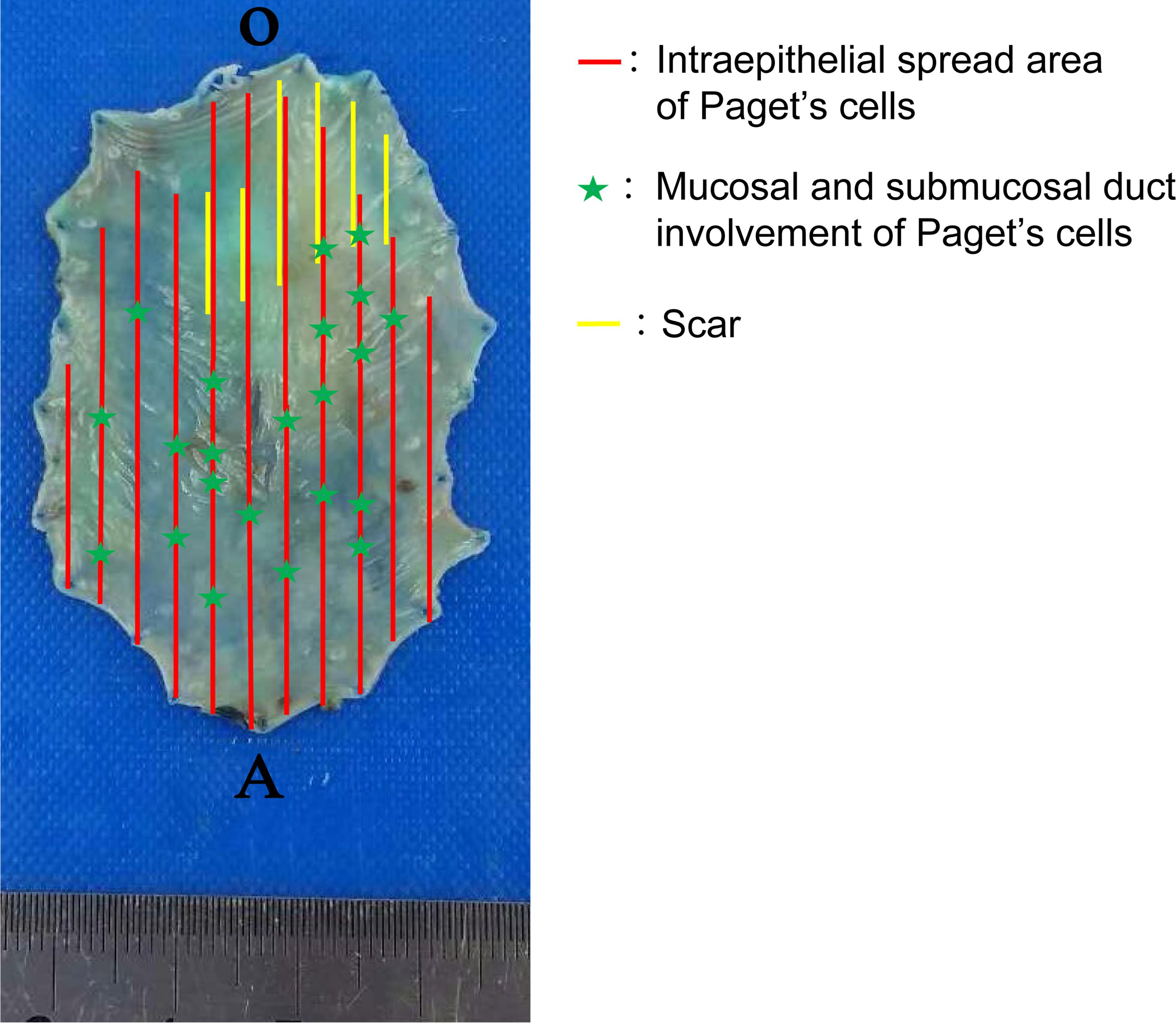 Mapping of the distribution of Paget’s cells and scar.