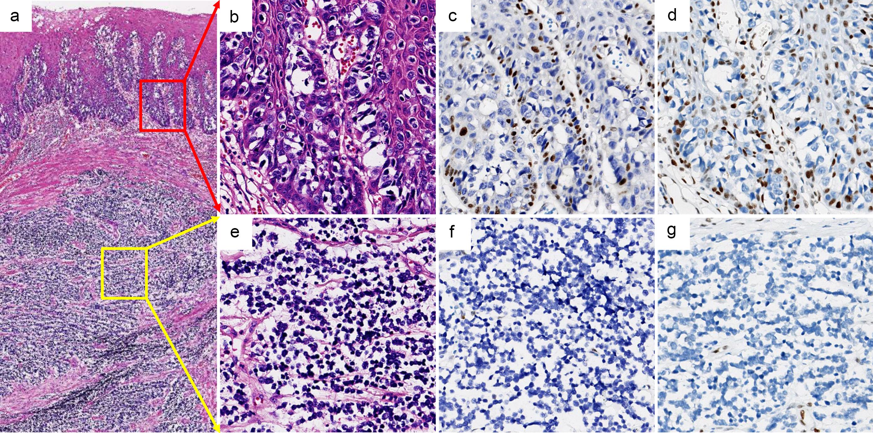 Pathological findings of esophageal Paget’s disease and small cell carcinoma.