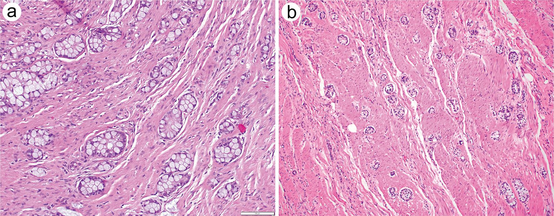 Low-grade patterns of goblet cell adenocarcinoma showing tumor clusters or tubules composed mainly of cohesive goblet-like mucinous cells.