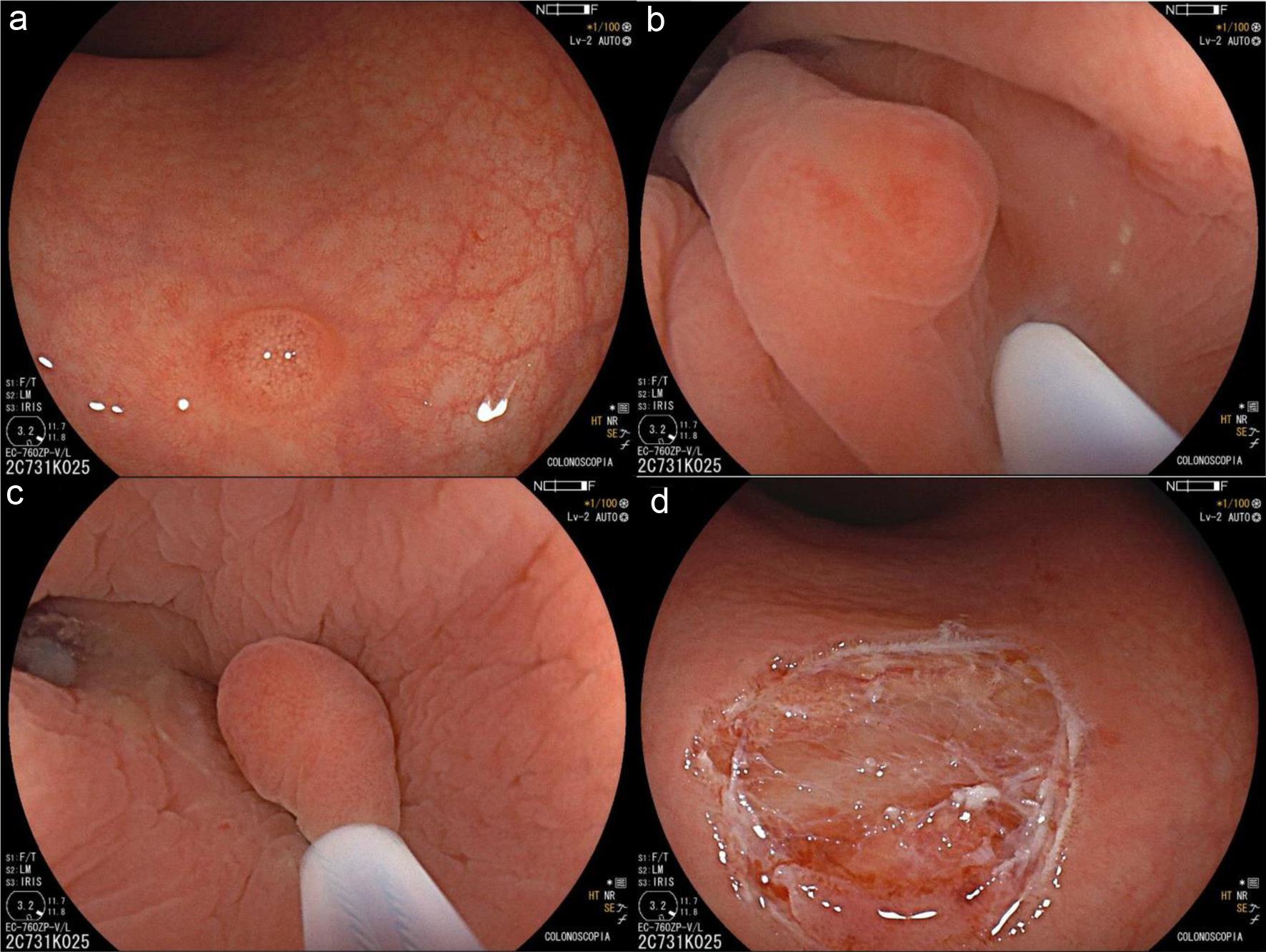 UEMR procedure for rectal NET.