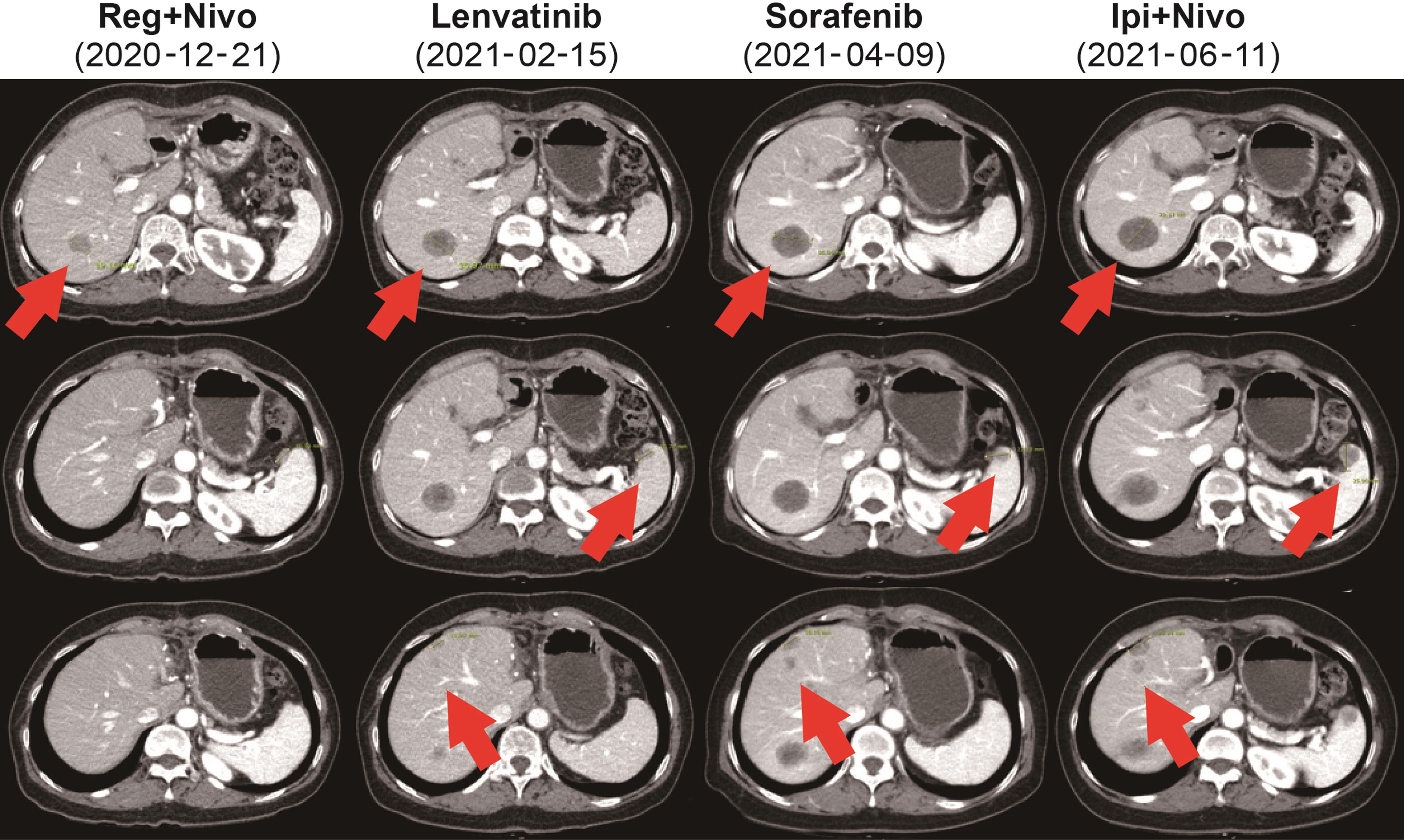 Dramatic Response to Cabozantinib in a Patient with Refractory ...