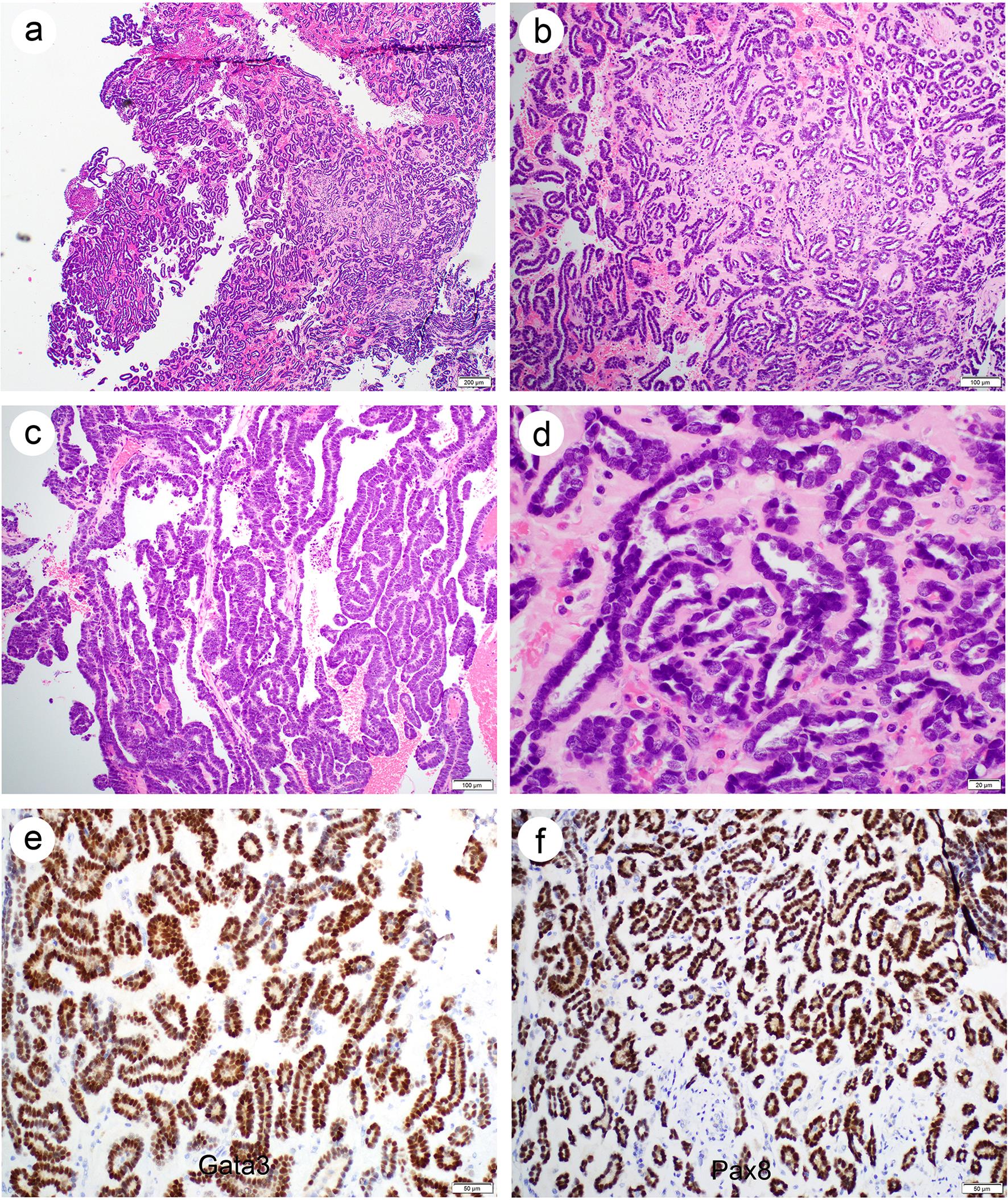 A mesonephric carcinoma (MC) of the uterine cervix with admixed growth patterns (a, 40×), including classic tubular (b, 100×) and papillary (c, 100×) architecture. Rare intraluminal eosinophilic secretions are present (d, 400×). The neoplastic cells are relatively uniform, with coarse or vesicular chromatin, irregular nuclear membranes, and occasional nuclear grooves (d, 400×). The neoplastic cells are diffusely and strongly positive for GATA3 (e, 200×) and PAX8 (f, 200×).