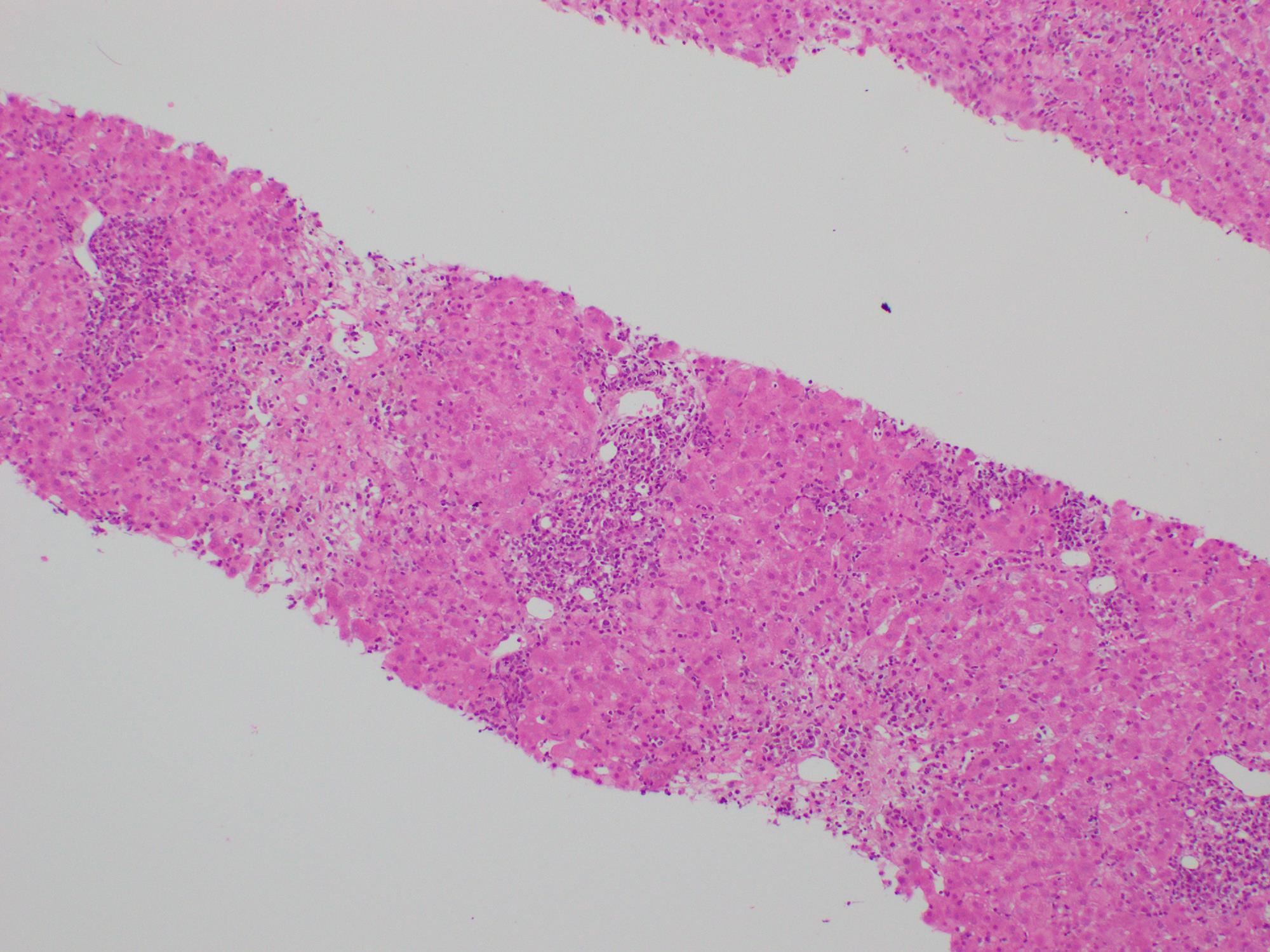 Both portal and lobular regions demonstrate a mixed inflammatory infiltrate with abundant plasma cells.