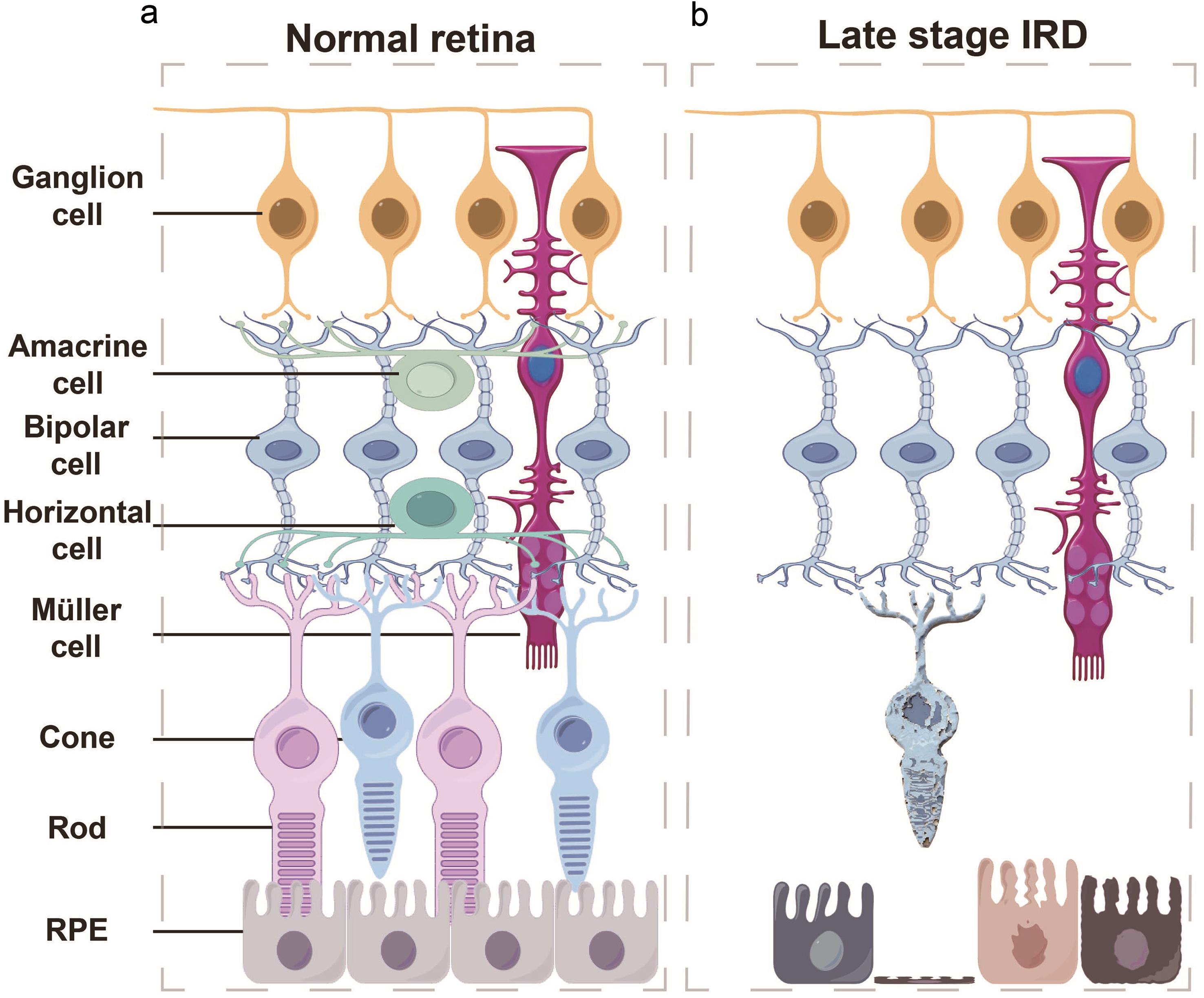 Retinal structure and degeneration in retinal degenerative diseases (RDDs). Retinal structure and degeneration in retinal degenerative diseases (RDDs).