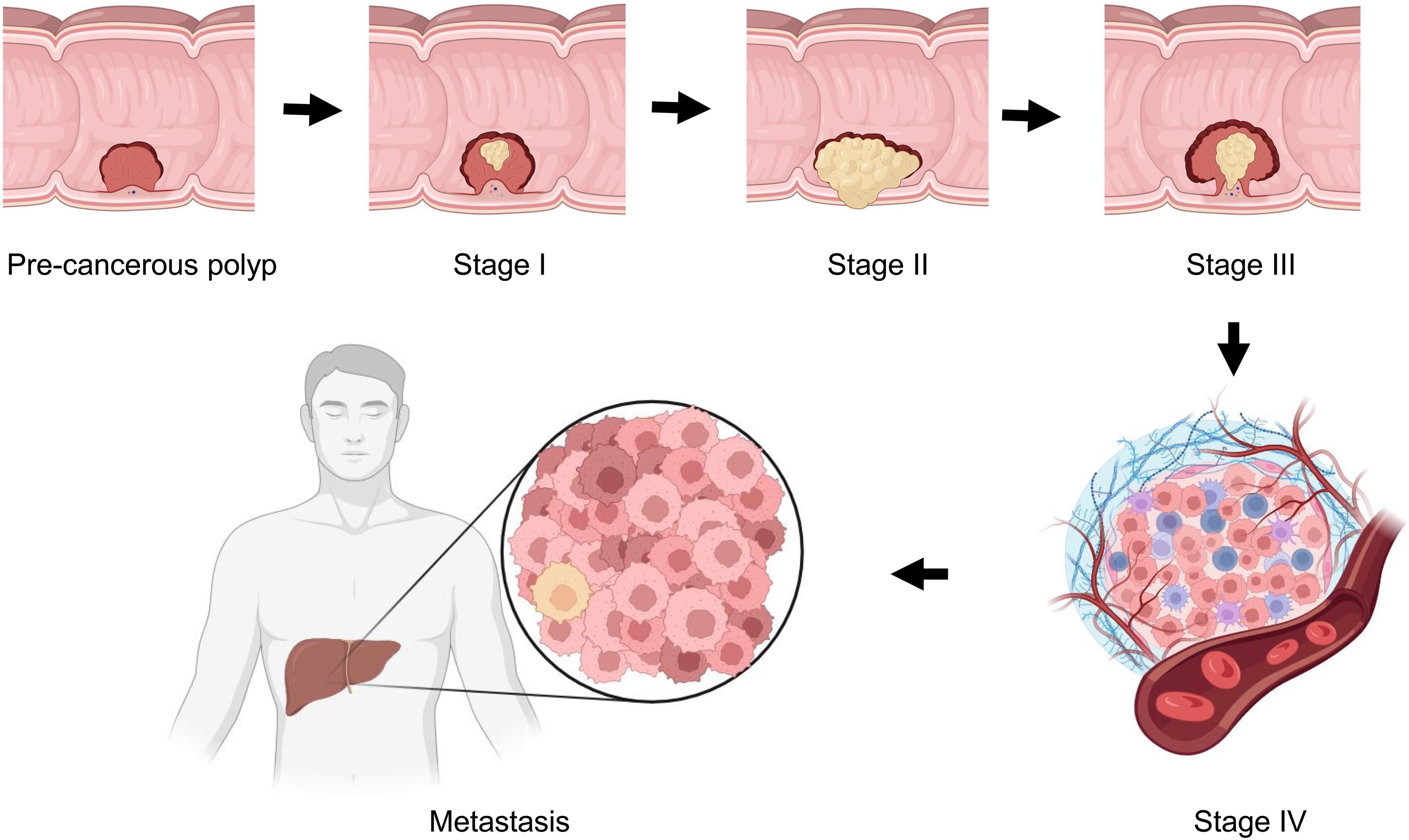 Progression of CRC, from pre-cancerous polyp through various stages.