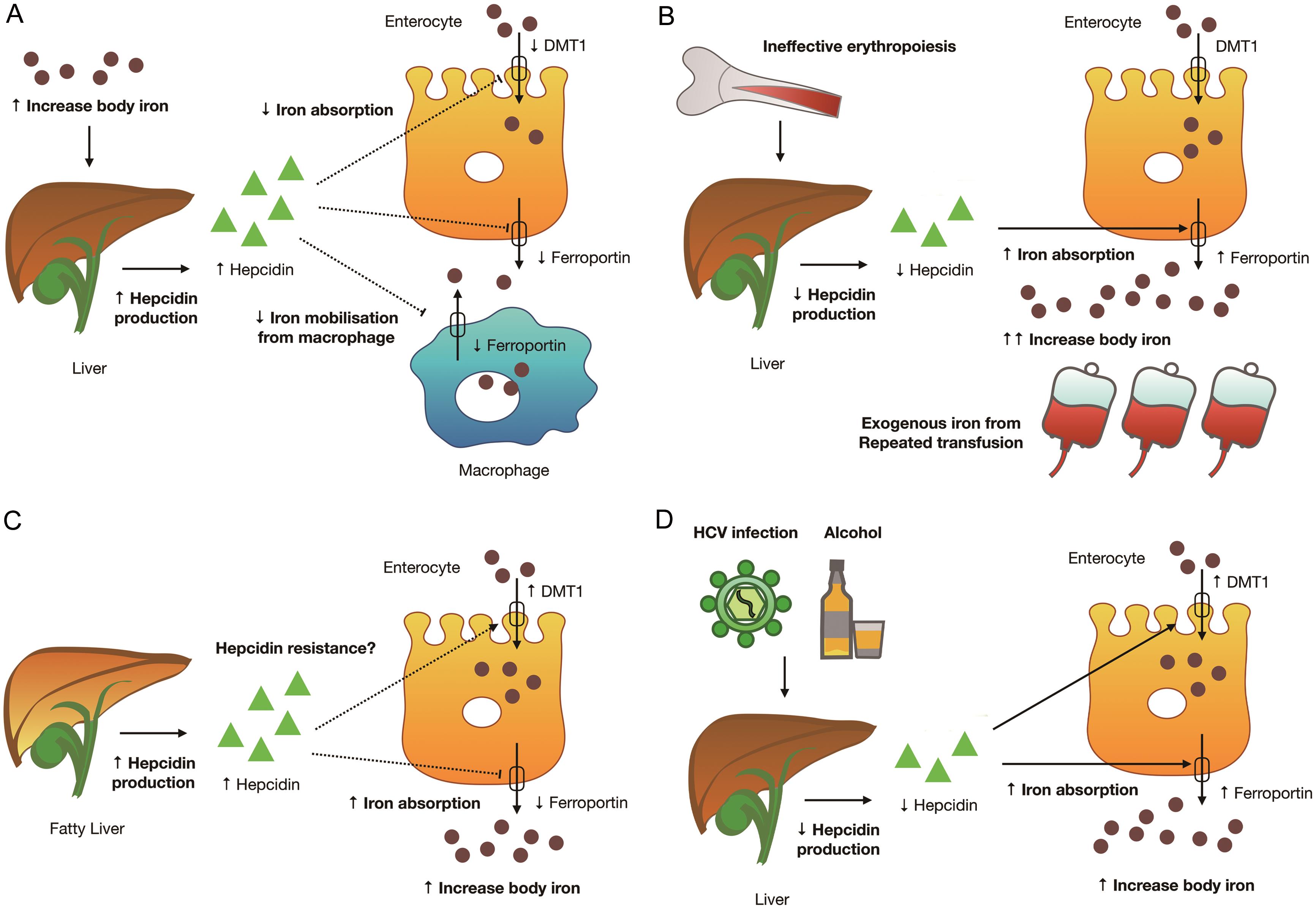 Secondary Iron Overload And The Liver A Comprehensive Review