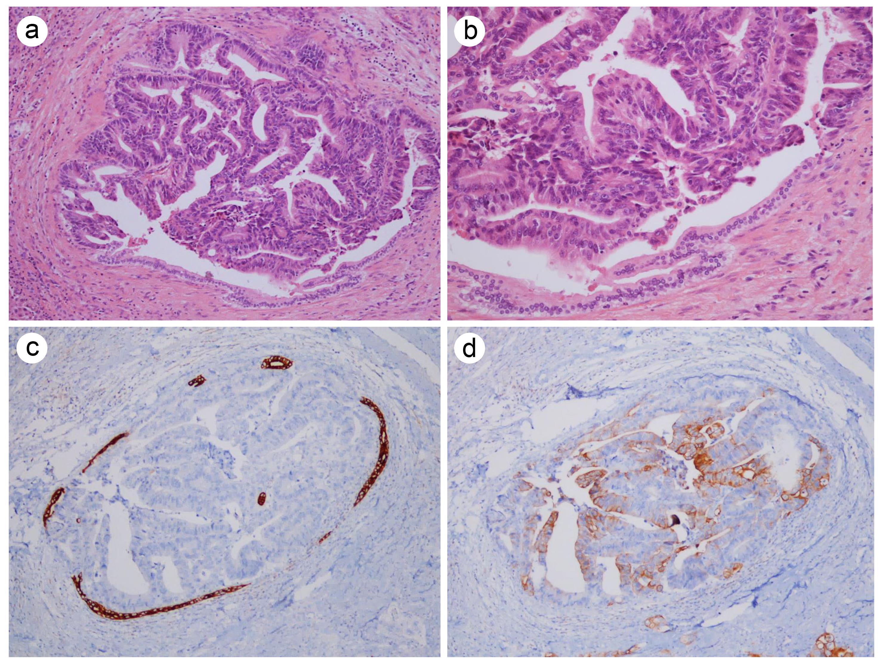 Histopathologic and immunohistochemical features of biliary duct invasion in colorectal liver metastasis.
