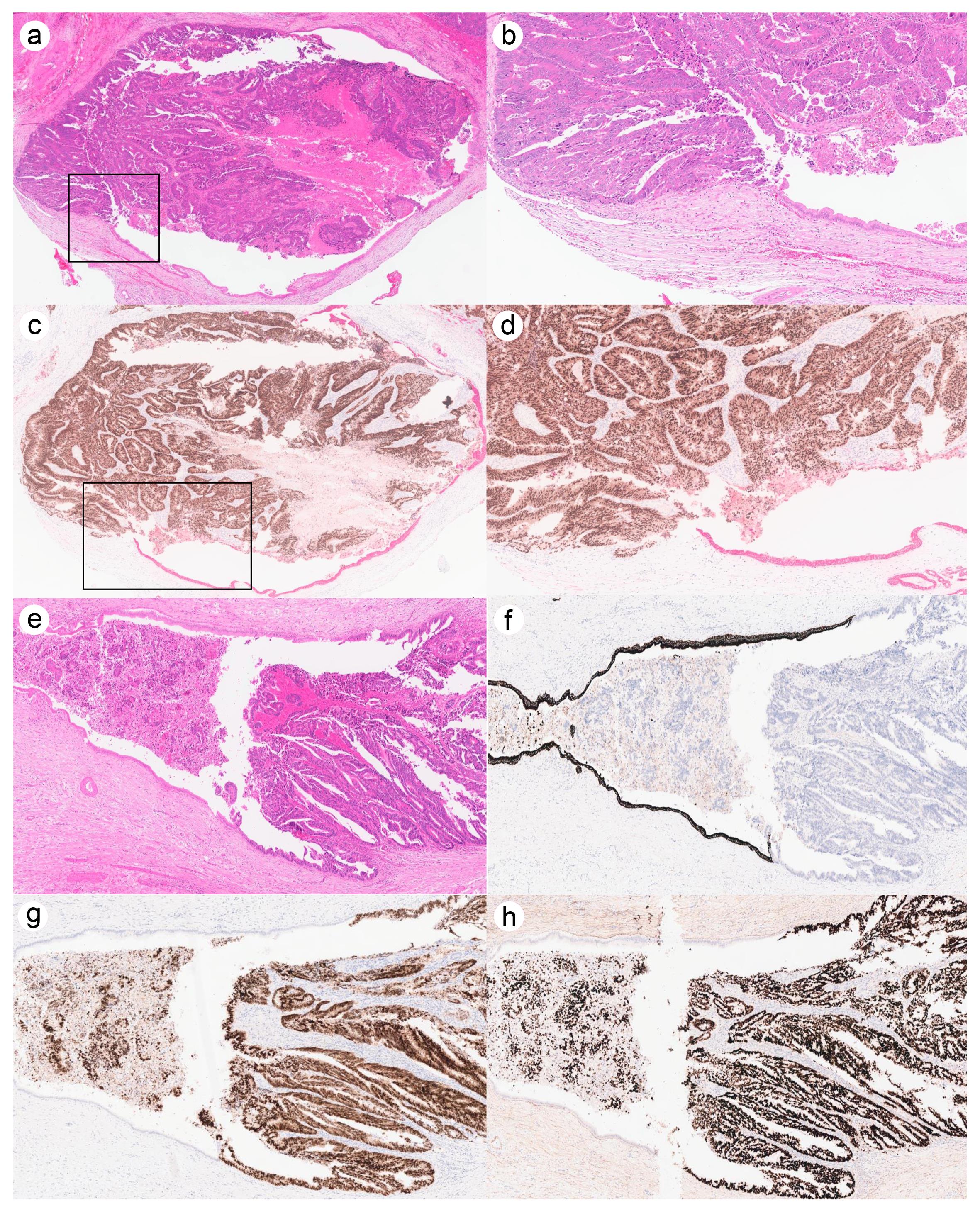 Histopathologic and immunohistochemical features of biliary duct invasion (BDI) in colorectal liver metastases.