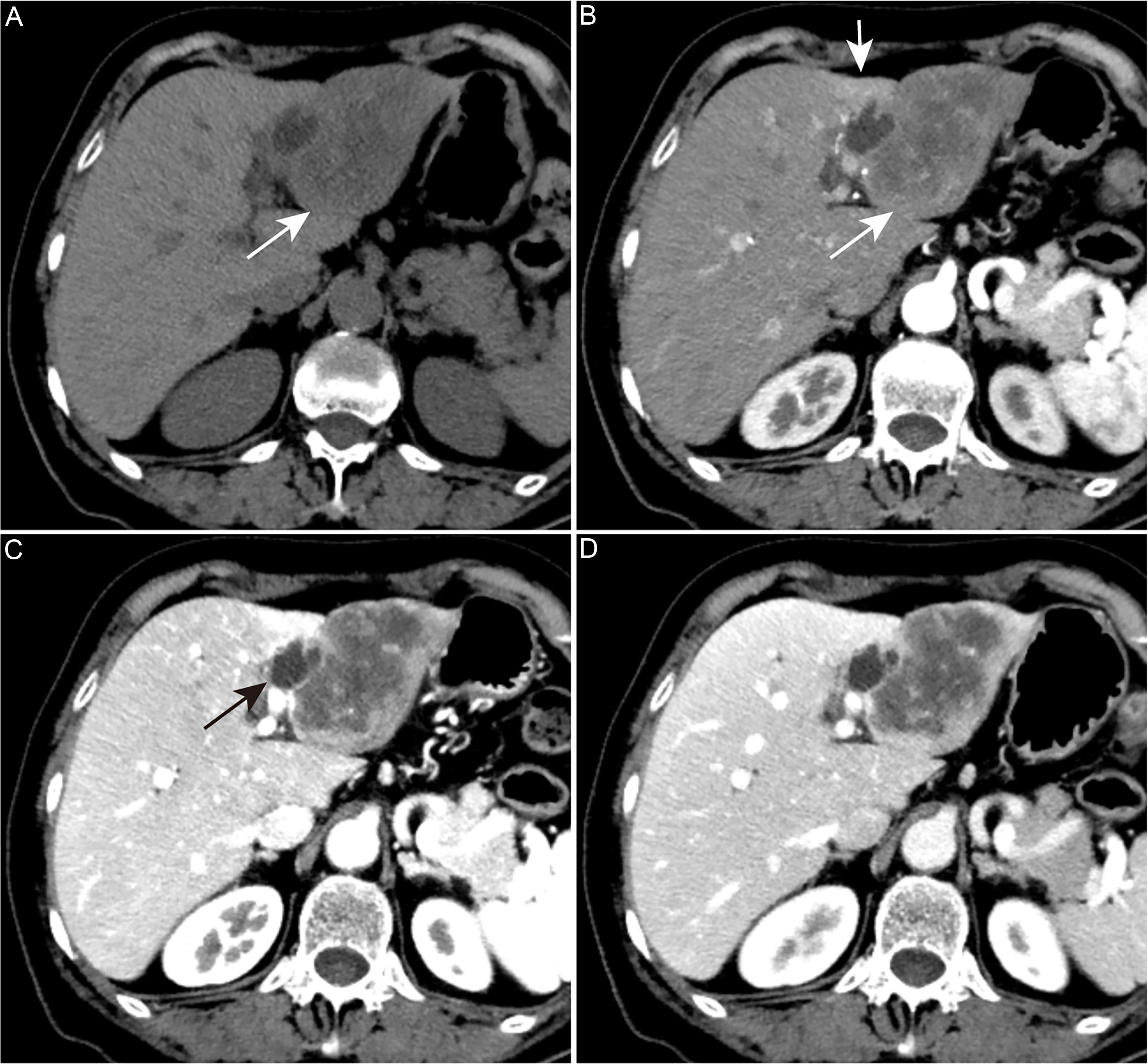 A 66-year-old female patient pathologically diagnosed with mass-forming LD-iCCA.