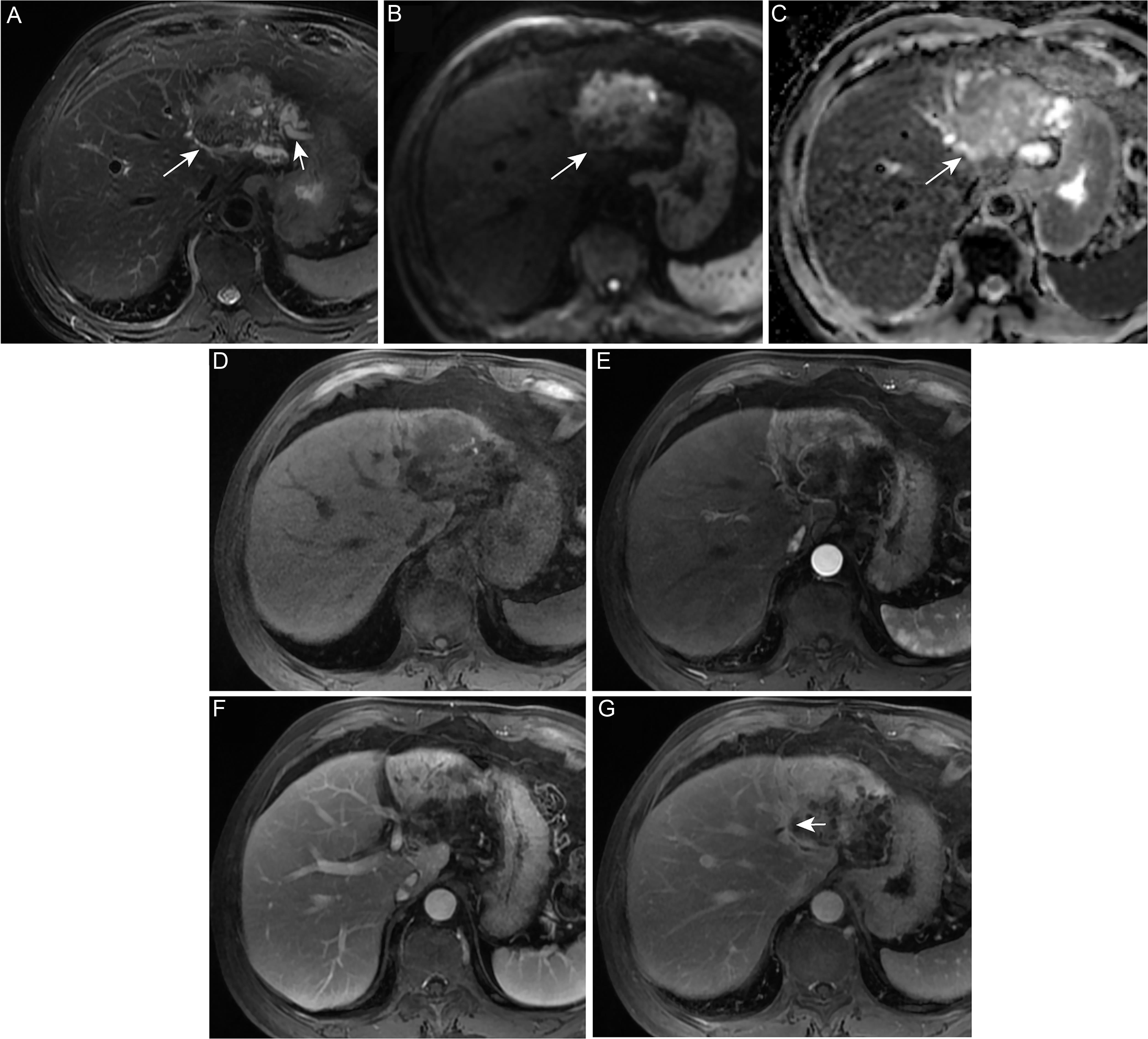 Images of a 69-year-old man with surgically confirmed LD-iCCA in the left lobe of the liver.