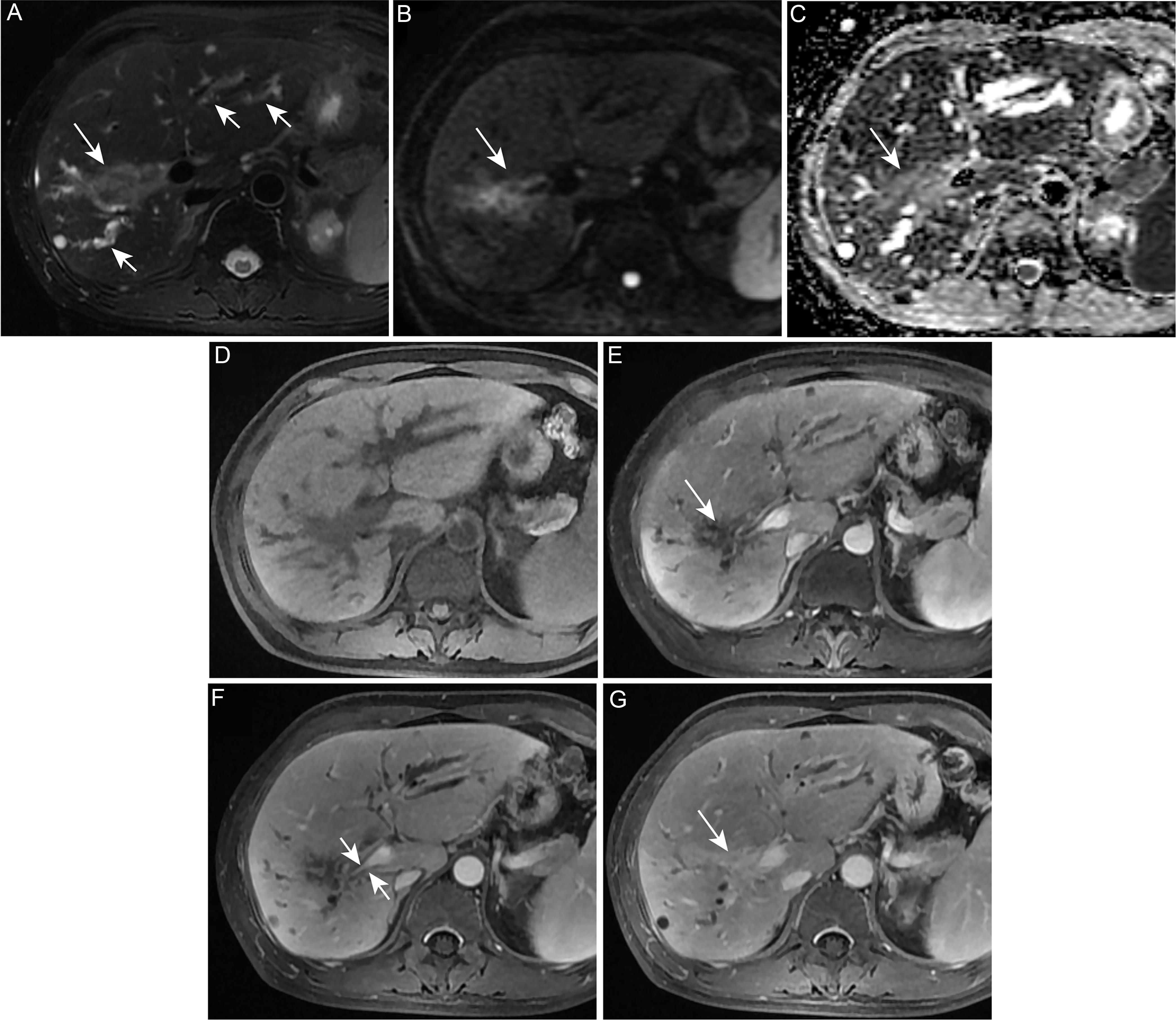 A 45-year-old male pathologically confirmed with mass-forming LD-iCCA.