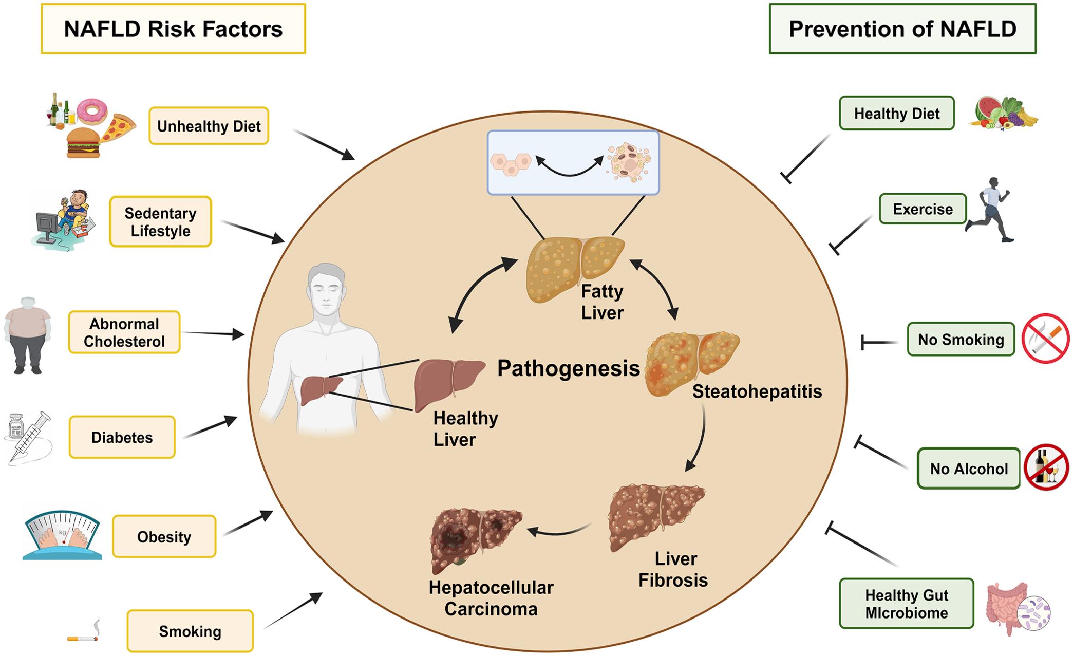 Illustration of common risks and the prevention of NAFLD. NAFLD, nonalcoholic fatty liver disease.