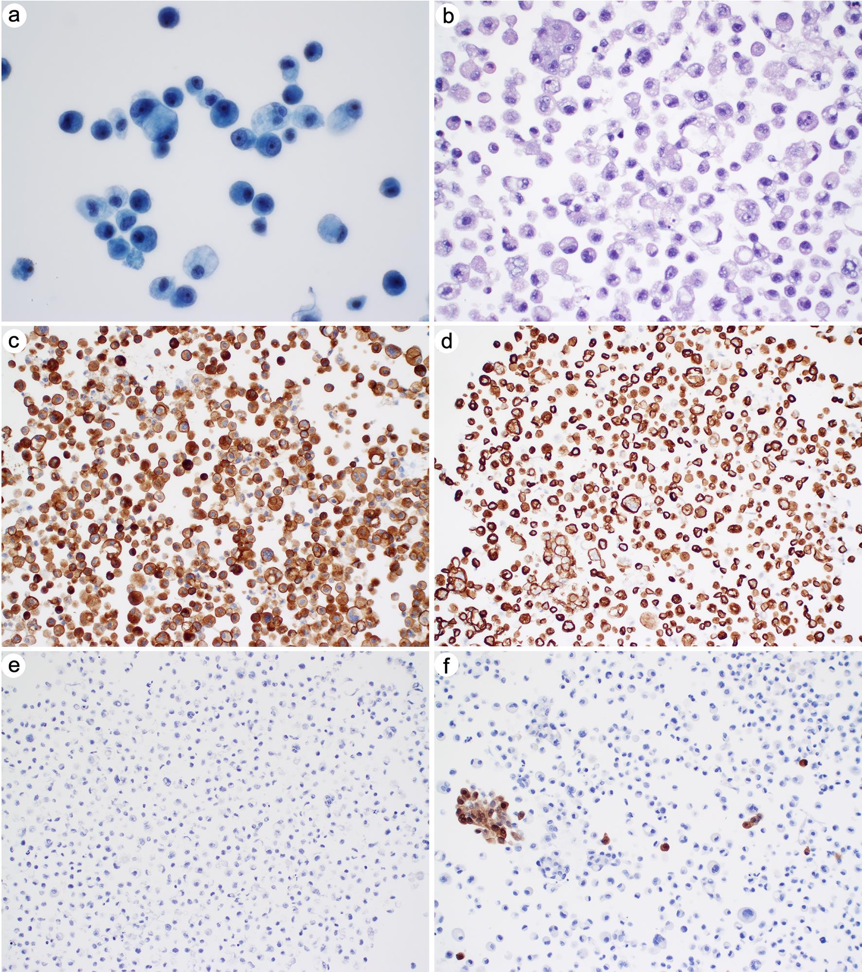 Metastatic adenocarcinoma of gastrointestinal primary.