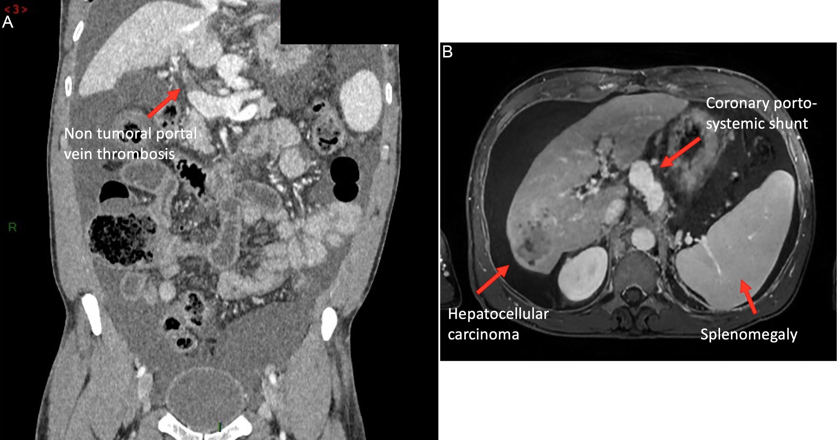 Pretransplant CT scan of the transplant recipient.