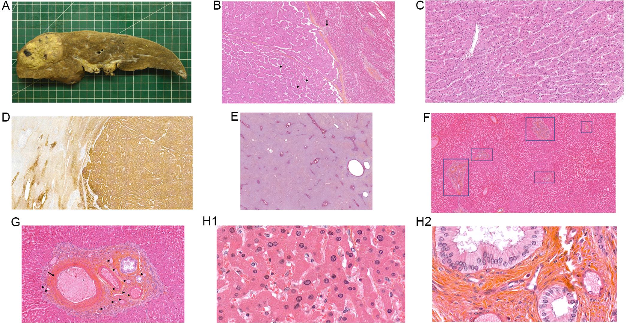 Histology of the explanted liver after 18-hour normothermic machine perfusion.