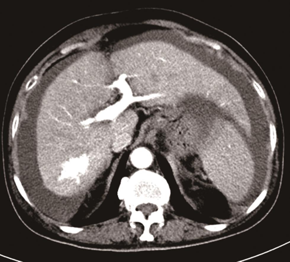 Representative computed tomography findings of HAPF showing early enhancement of the portal vein in the arterial phase.