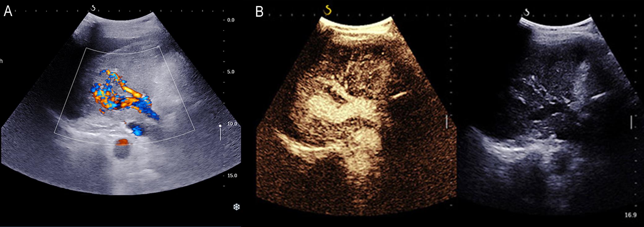 Ultrasound image showing HAPFs under Doppler (A) and Sonovue contrast (B).