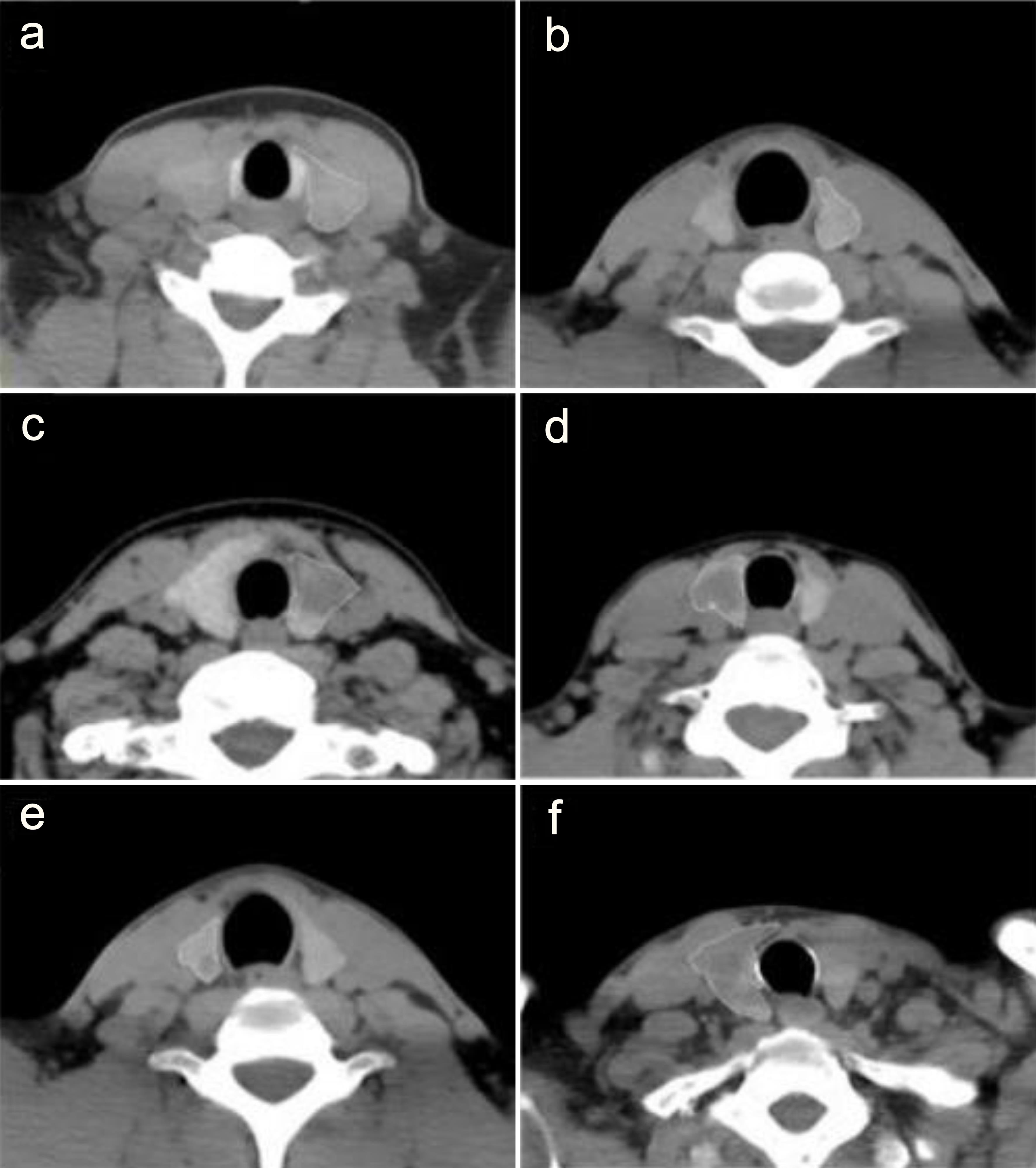 Computed tomography images of benign and malignant thyroid tissue.
