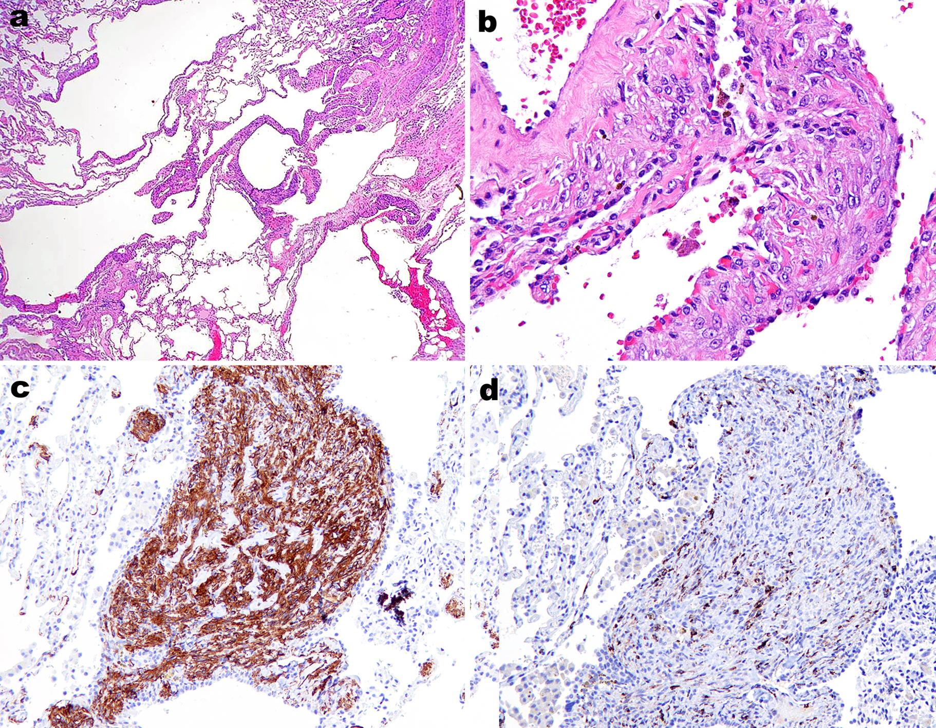 Lymphangioleiomyomatosis (LAM).