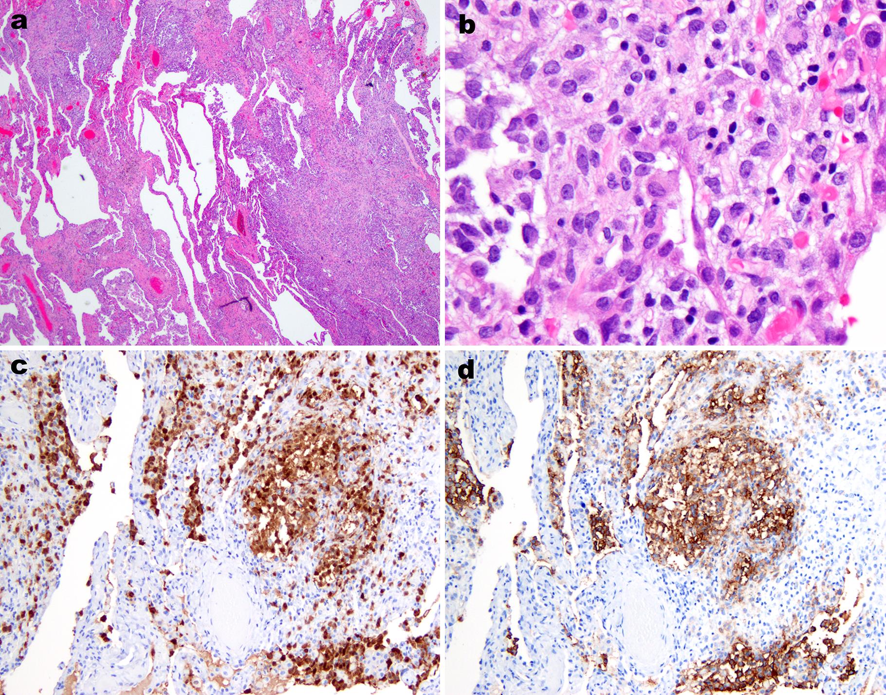 Langerhans cell histiocytosis (LCH).