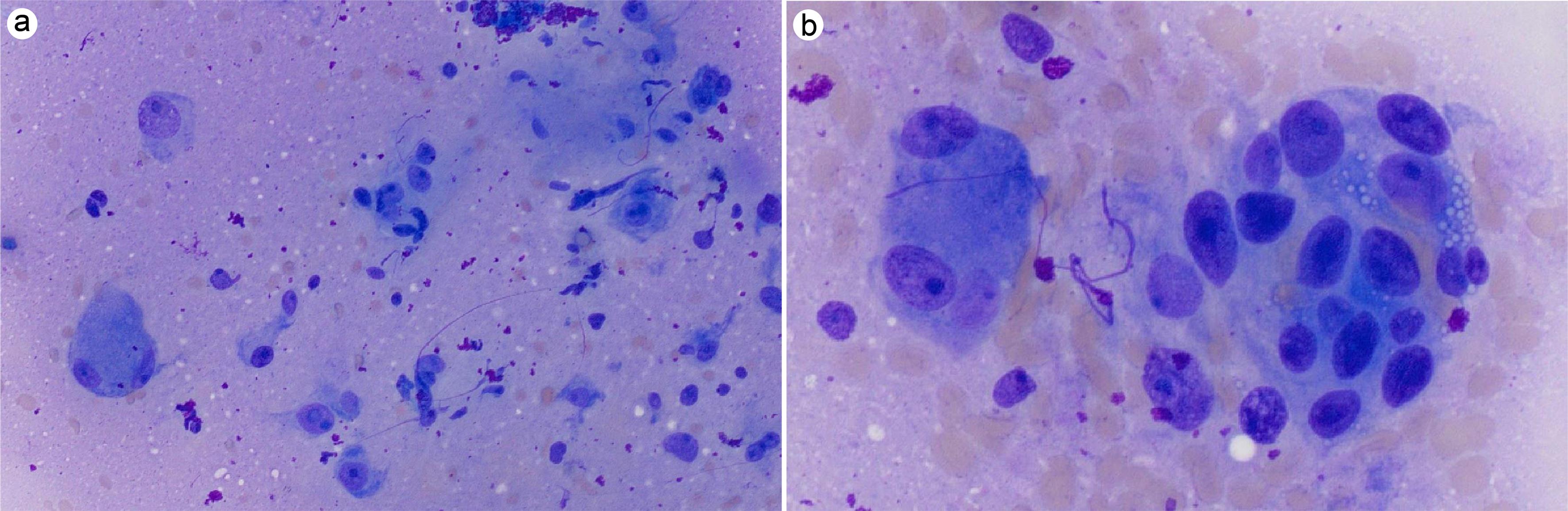 (a) Touch prep Diff-Quick staining shows numerous multinucleated giant cells, some of which have between 10 and 20 nuclei. (b) These nuclei typically have smooth nuclear membranes and prominent nucleoli.