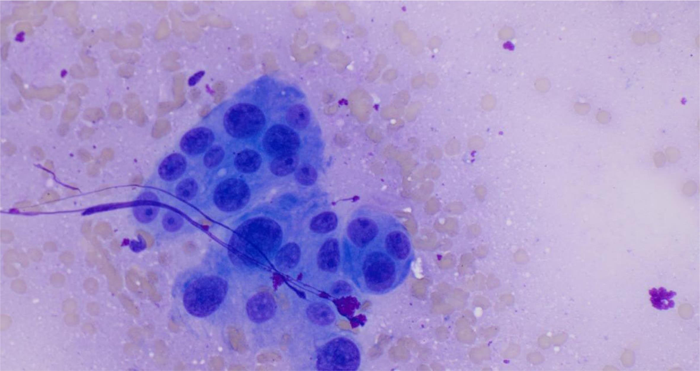 These multinucleated giant cells are difficult to differentiate from osteoclast giant cells.