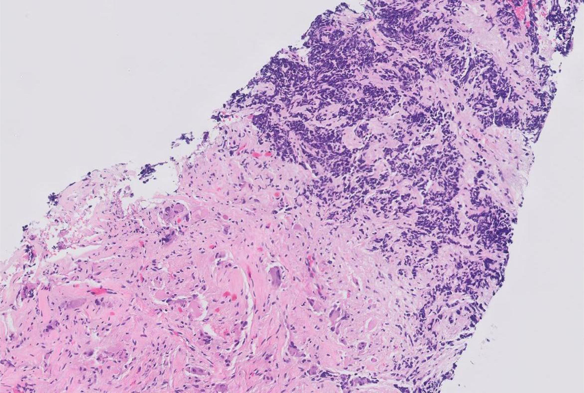 These multinucleated giant cells are appreciated on regular H&E stained biopsy, mostly in more differentiated areas, i.e. favorable nodules.