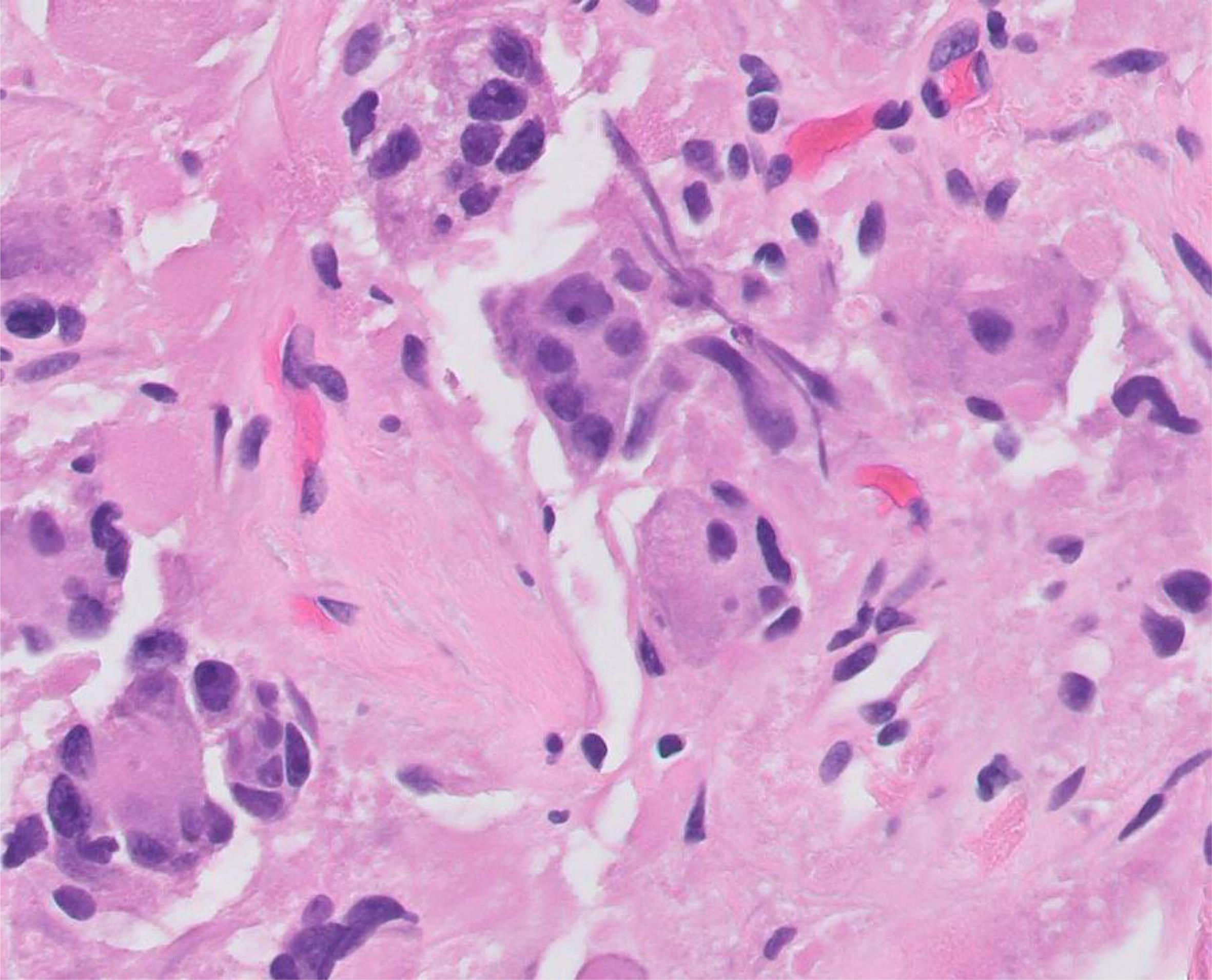 These multinucleated giant cells are maturing neuroblasts or immature ganglion cells.