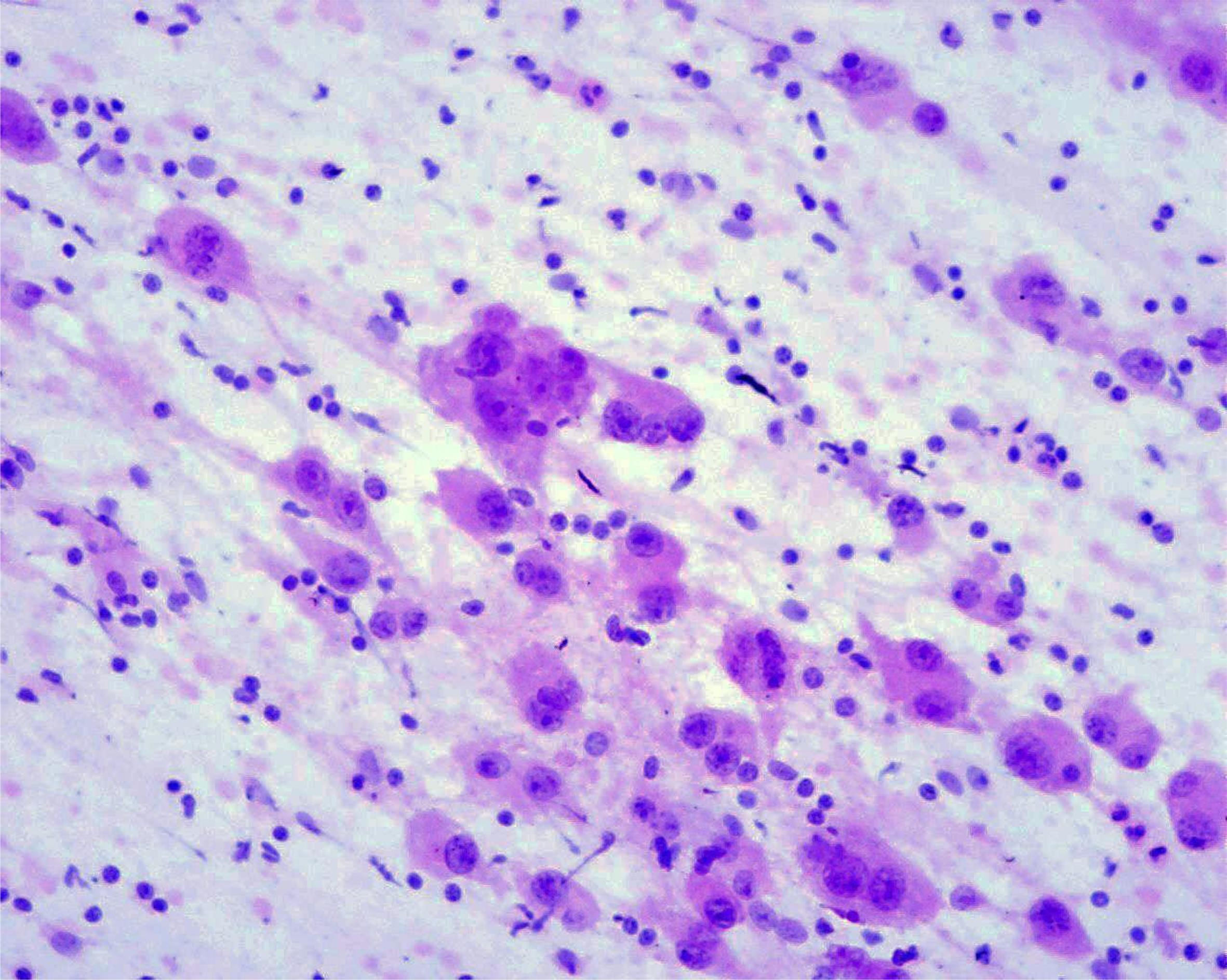 Multinucleated ganglion cells from the website of European Federation of Cytology.