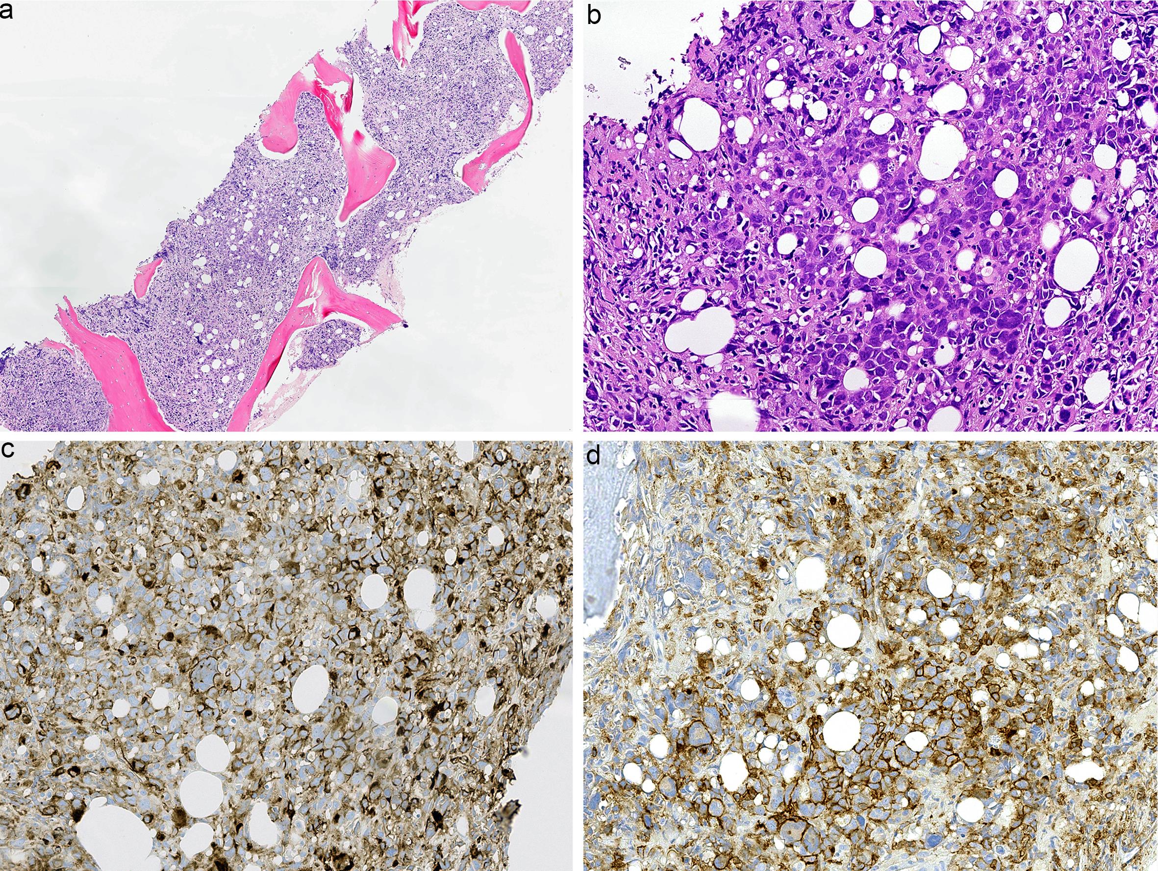 Hematoxylin and eosin-stained section of bone marrow shows extensive infiltration of large and anaplastic cells (a, b). The atypical cells are positive for CD43 (c) and CD31 (d), consistent with acute megakaryoblastic leukemia.