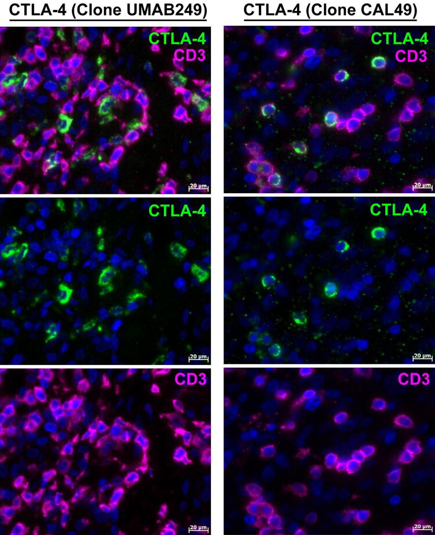 Expression of the CTLA-4 antigen in T lymphocytes in the human melanoma using anti-CTLA-4 antibodies against the UMAB249 and CAL49 clones.