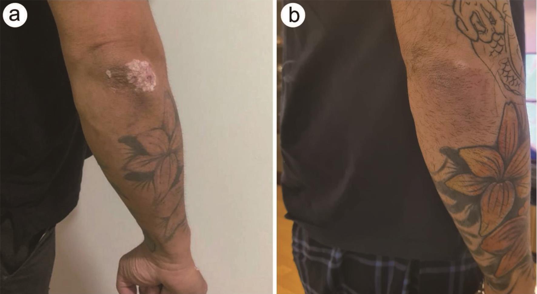 Elbow of the patient before and after the application of “Psorisbye” with 1 week between images.