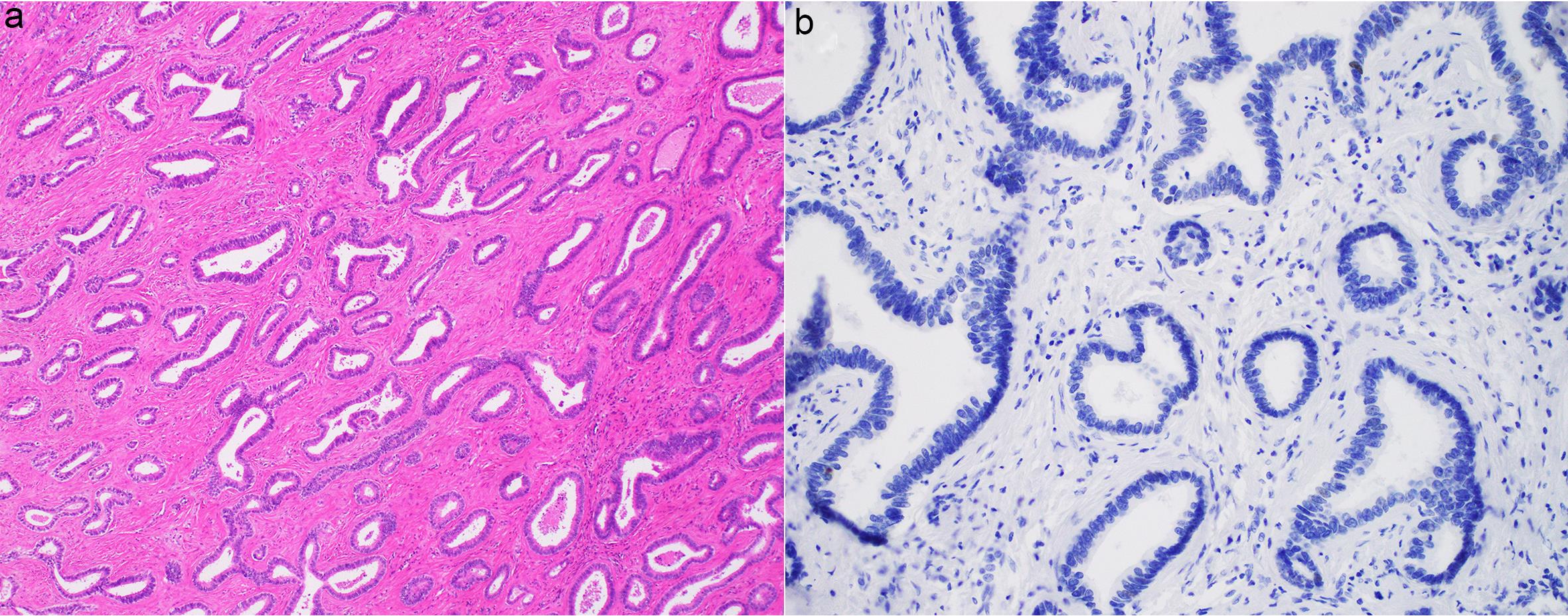 A rare case of biliary adenofibroma showing proliferation of individual biliary tubules and microcystic structures within a fibrous stroma (a). The tumor shows an extremely low Ki67 proliferation index in both the epithelium and stroma (b).