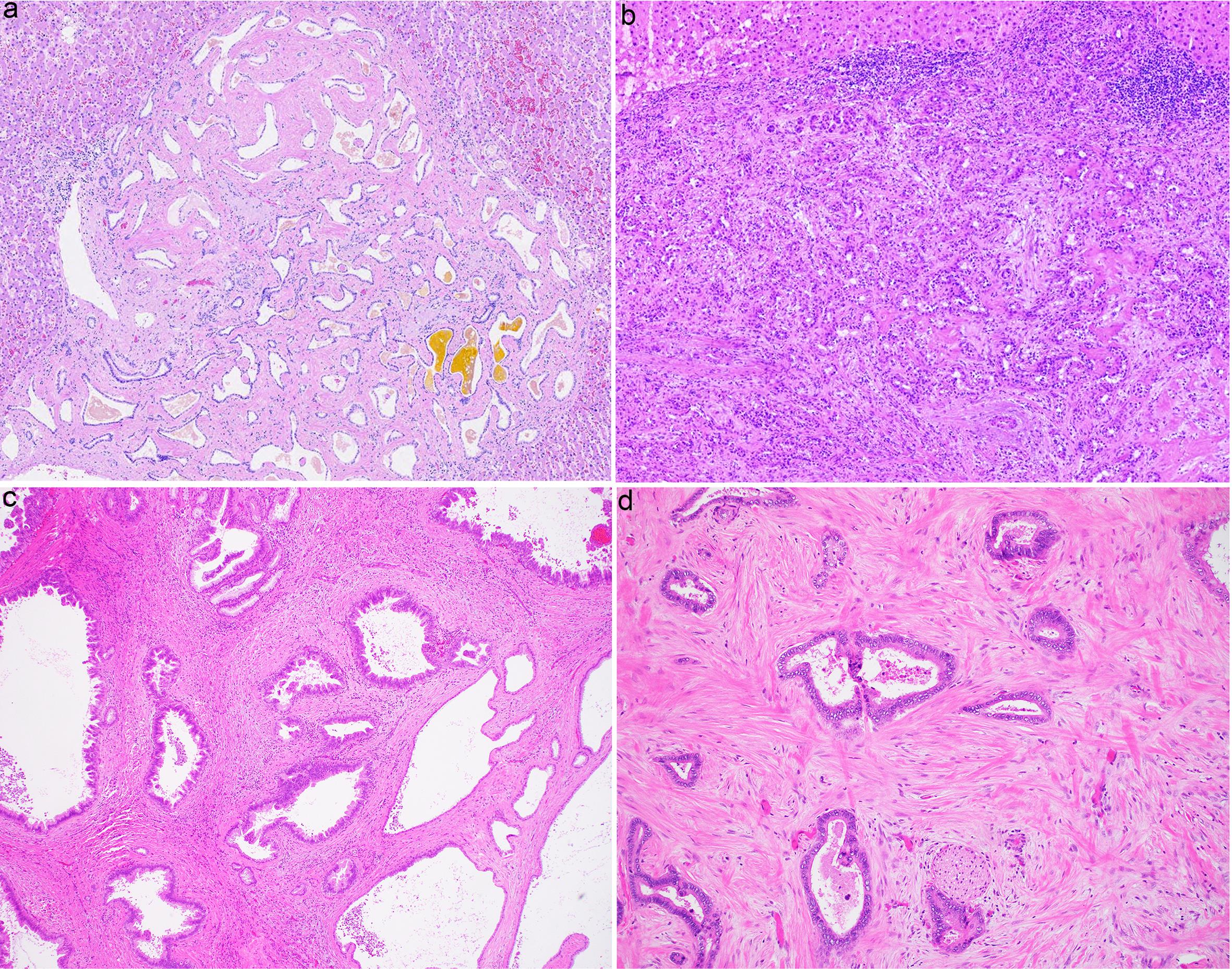 Entities that mimic biliary adenofibroma.