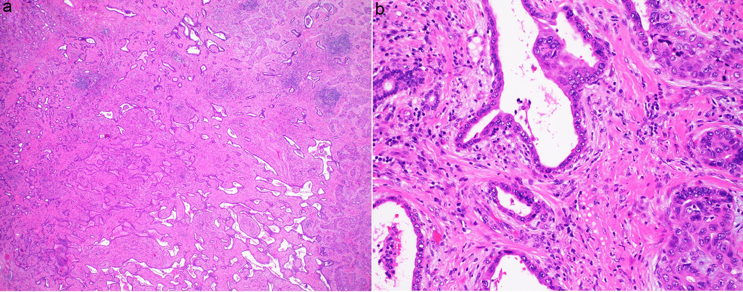 An intrahepatic cholangiocarcinoma showing mixed histologic patterns, characterized by low-grade tubulocystic morphology that may be misinterpreted as a biliary adenofibroma at the bottom, a classic cholangiolocellular carcinoma pattern on the right, and a ductal plate malformation-like pattern on the left (a). Higher power shows the transition of the lower-grade microcystic component to the higher-grade solid component of this tumor (b), both components sharing similar nuclear features.