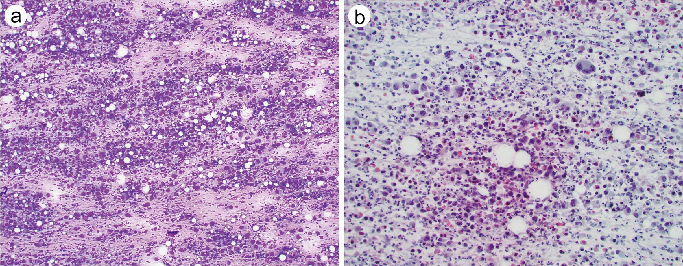 Cytology features of undifferentiated (anaplastic) thyroid carcinoma.