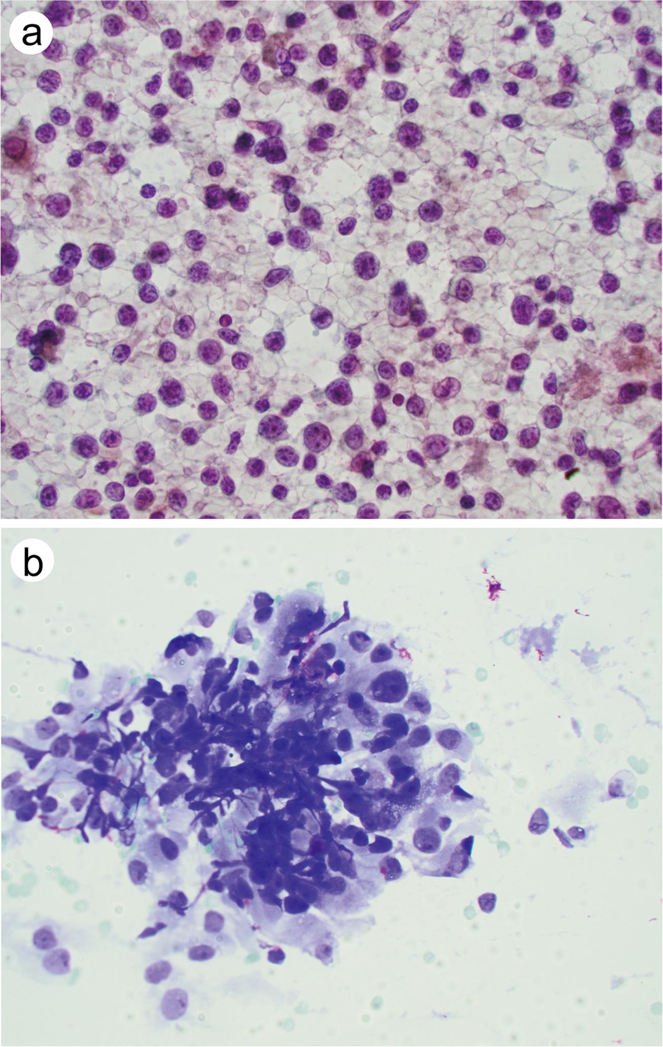 Cytologic features of other rare tumors of the thyroid.