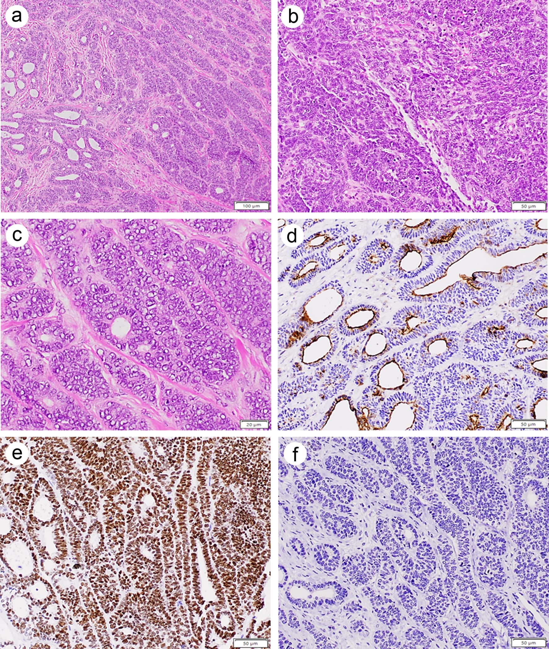 A mesonephric-like adenocarcinoma (MLA) of the ovary showing tubular and trabecular (a, 100×), solid and spindled (b, 200×) architecture. The nuclei exhibit open chromatin, irregular nuclear contours, and frequent nuclear grooves, reminiscent of papillary thyroid carcinoma (c, 400×). Neoplastic cells are positive for luminal CD10 (d, 200×) and TTF1 (e, 200×), but negative for GATA3 (f, 200×).