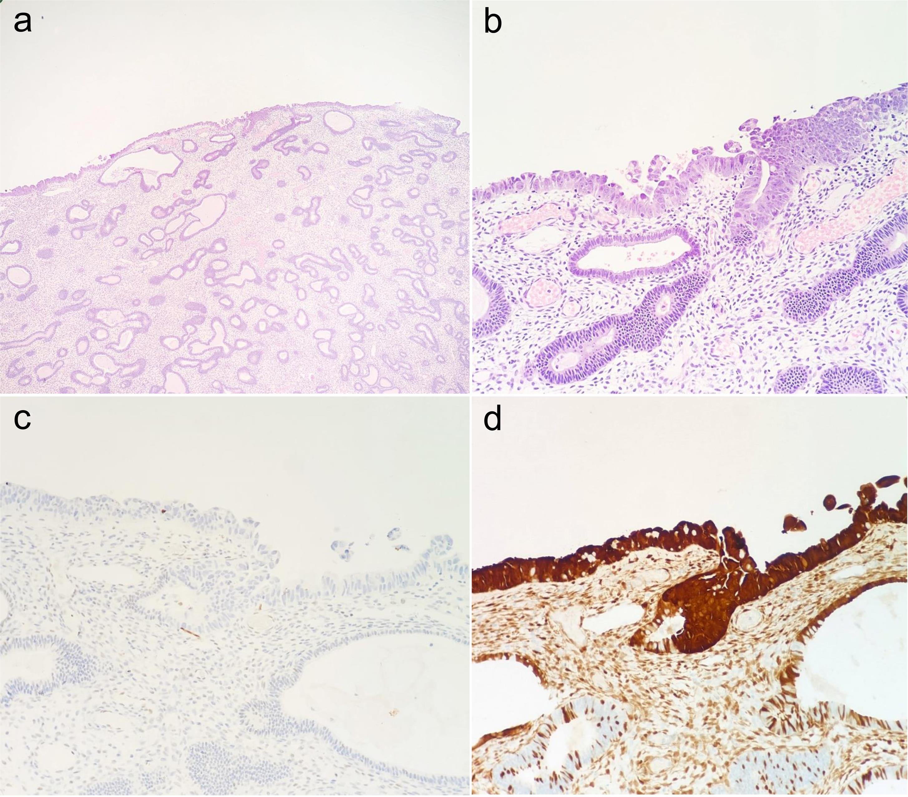 A case of serous endometrial intraepithelial carcinoma (SEIC) on the surface of an endometrial polyp.