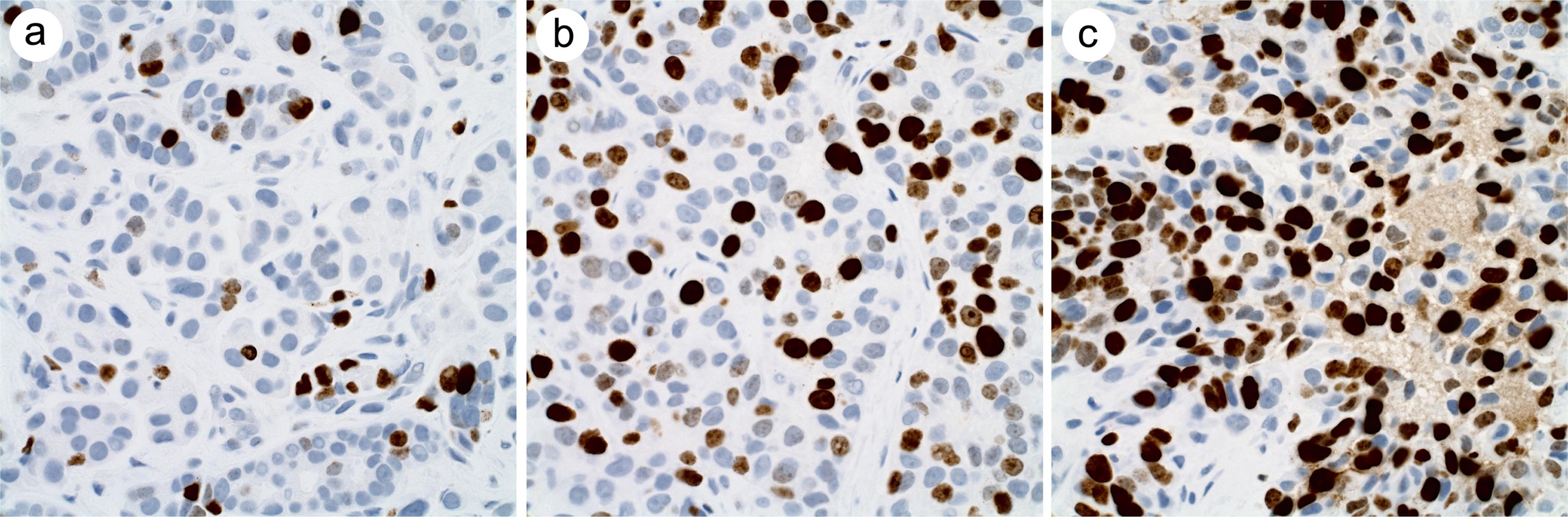 Ki-67 IHC was variably percentage and intensity.