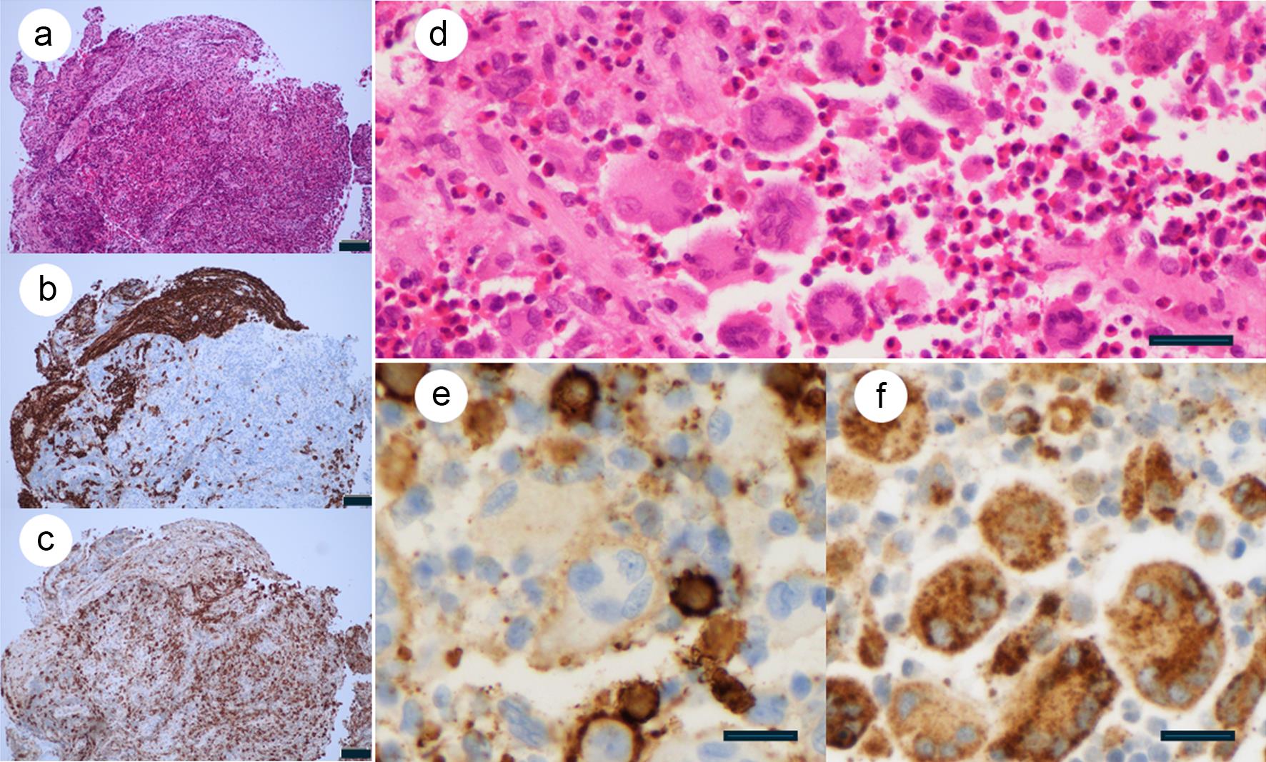 Histology of mixed histiocytosis (LCH/ECD).