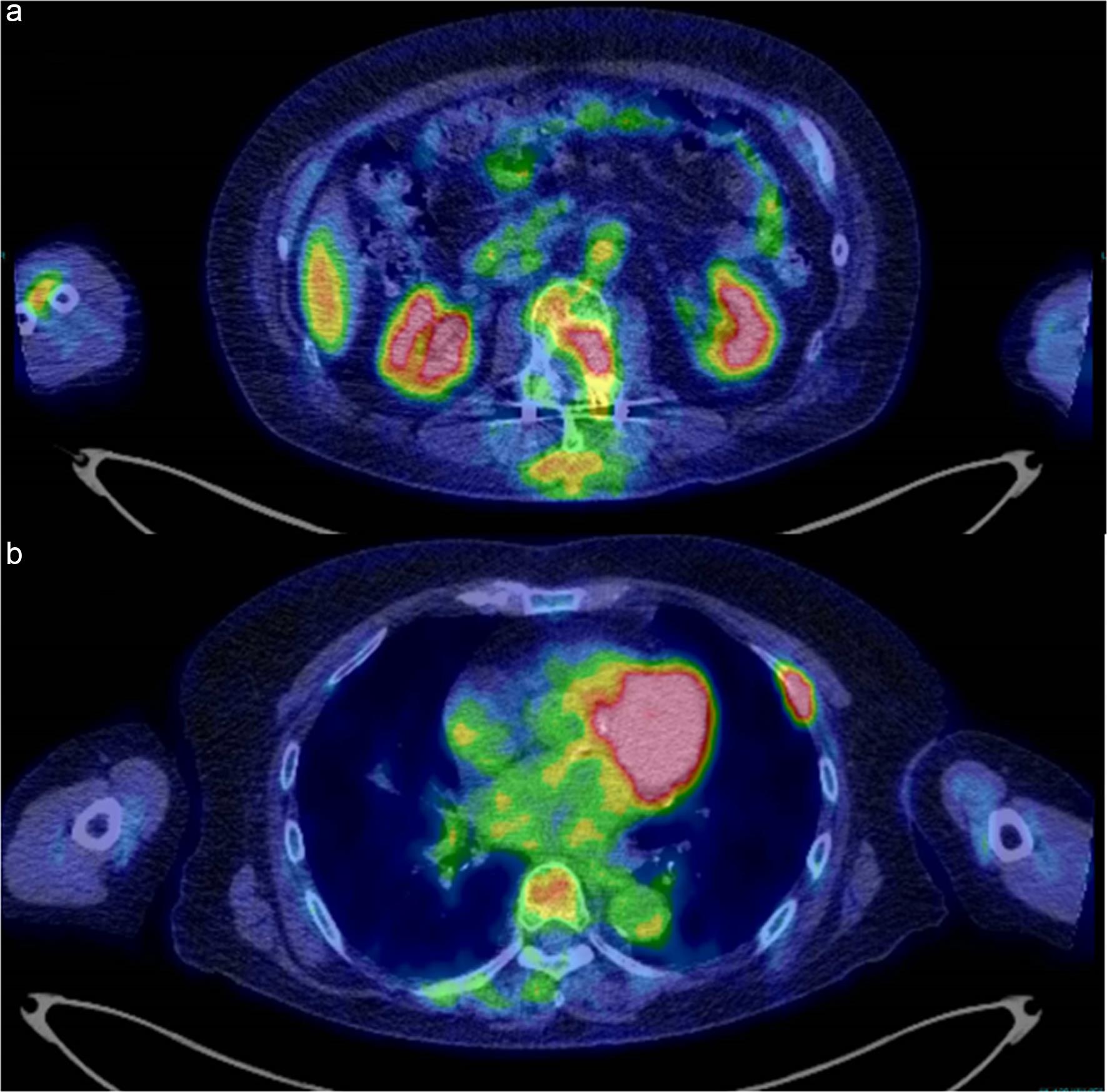 PET/CT images of the refractory histiocytic lesions after chemotherapy with the CHOP regimen.