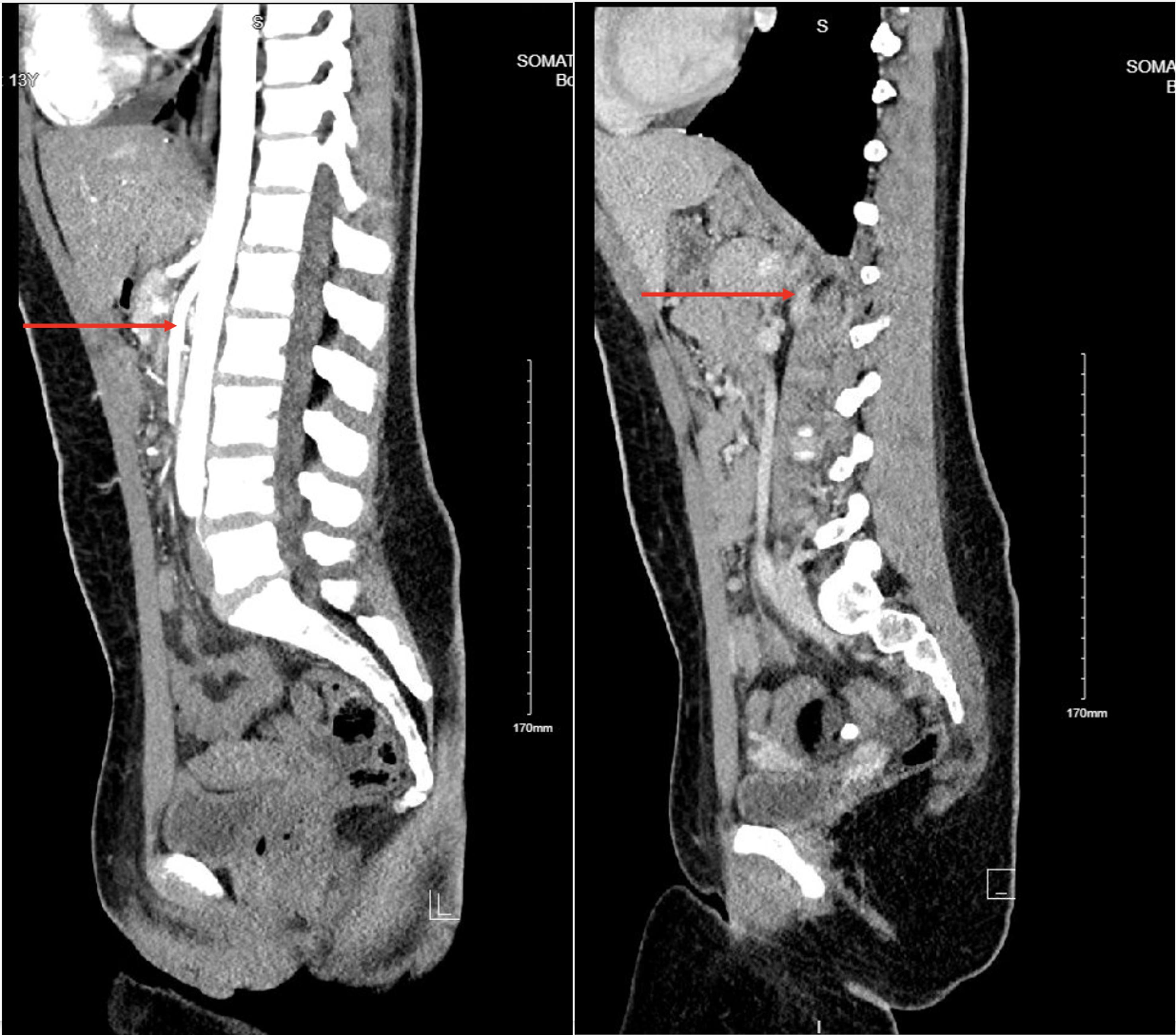 CT abdomen, sagittal views.