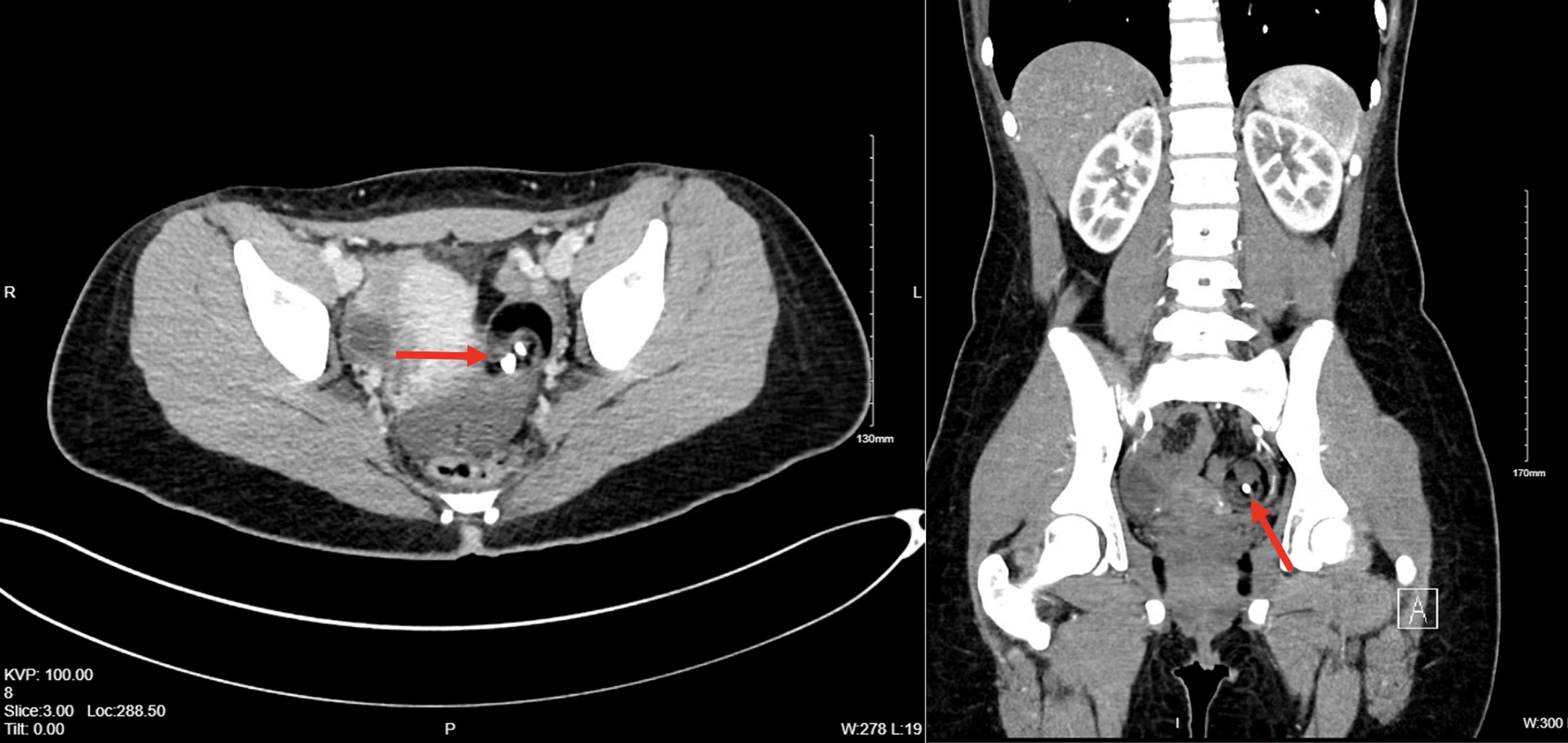 Pelvic ultrasound images demonstrating a 3.4 × 2.9 × 3.2 cm left ovarian dermoid cyst (red arrow) and a 2.1 cm simple right ovarian cyst (red arrow).