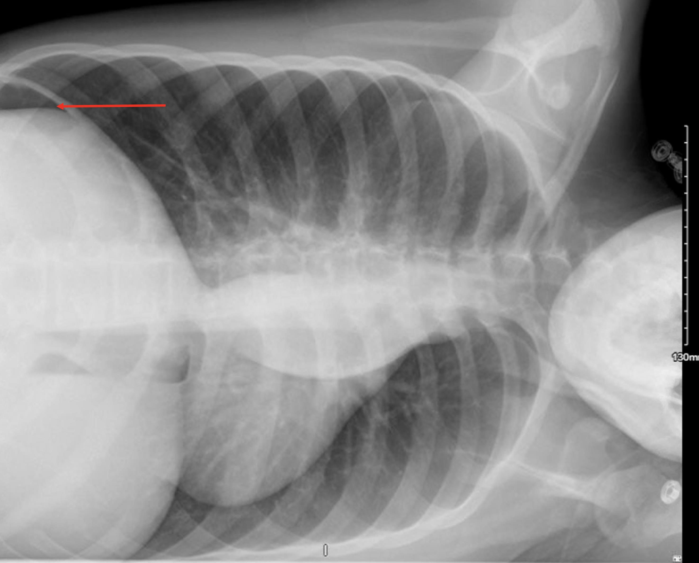Postoperative chest X-ray demonstrating residual pneumoperitoneum following laparoscopic procedure.