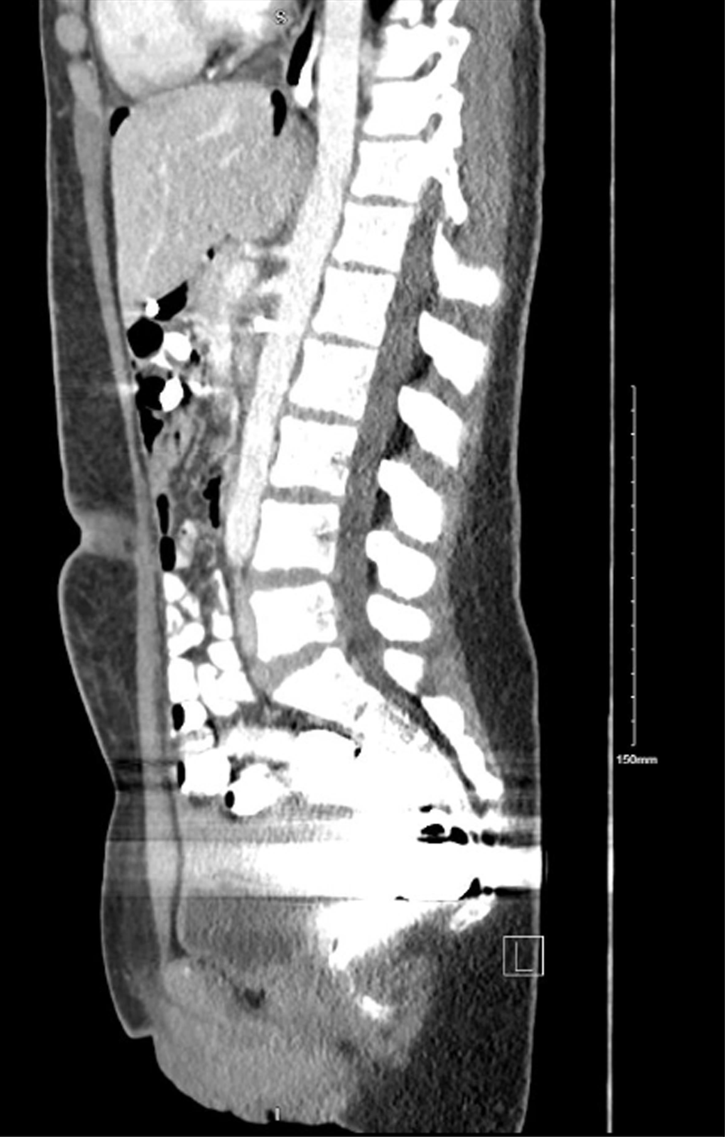 Sagittal view CT abdomen and pelvis for re-evaluation of SMA syndrome on postoperative day 4.
