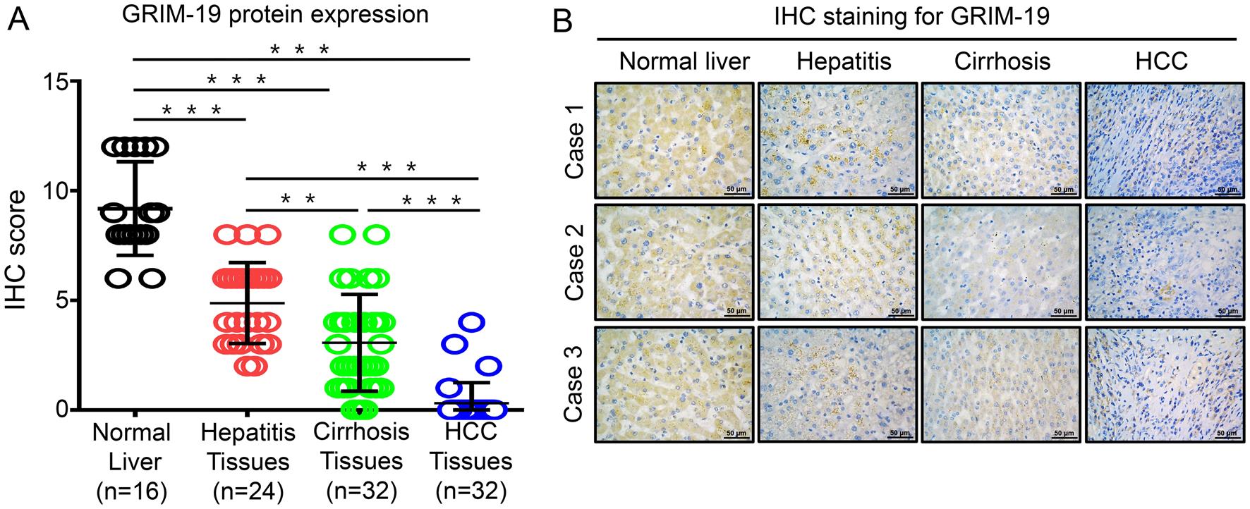 GRIM19 (gene associated with retinoid-IFN-induced mortality 19) is downregulated in human chronic liver disease tissues.