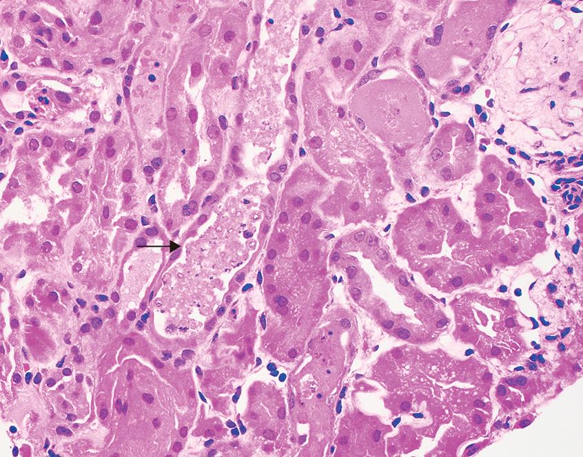 Renal biopsy findings in acute tubular necrosis.