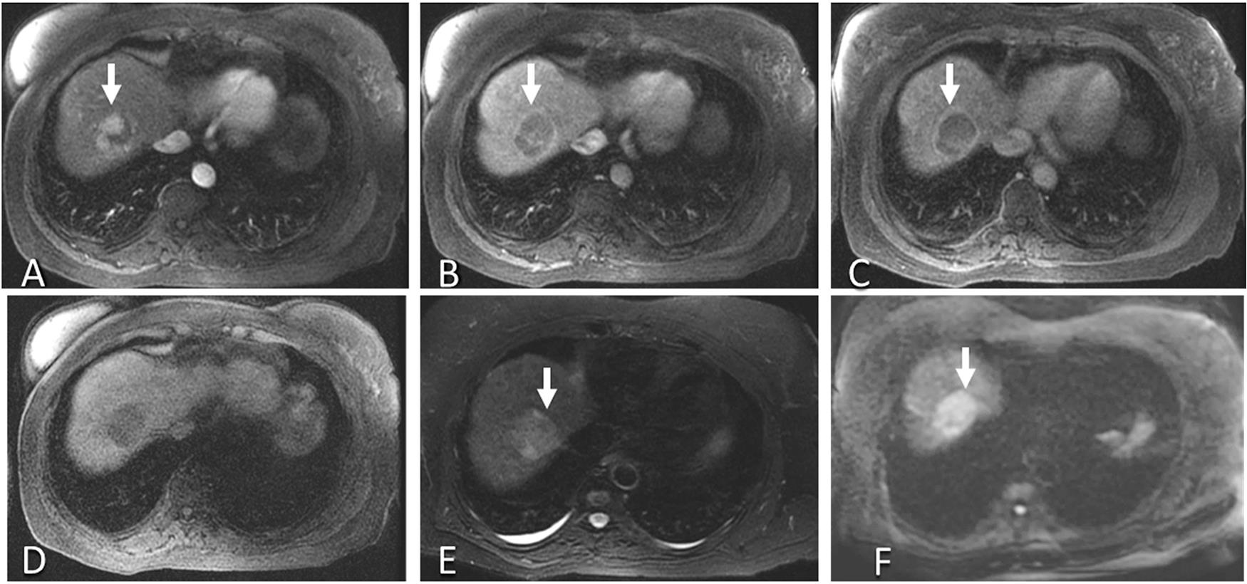 Axial magnetic resonance imaging of the HCC in a 57-year-old patient with cirrhosis secondary to chronic hepatitis C infection.