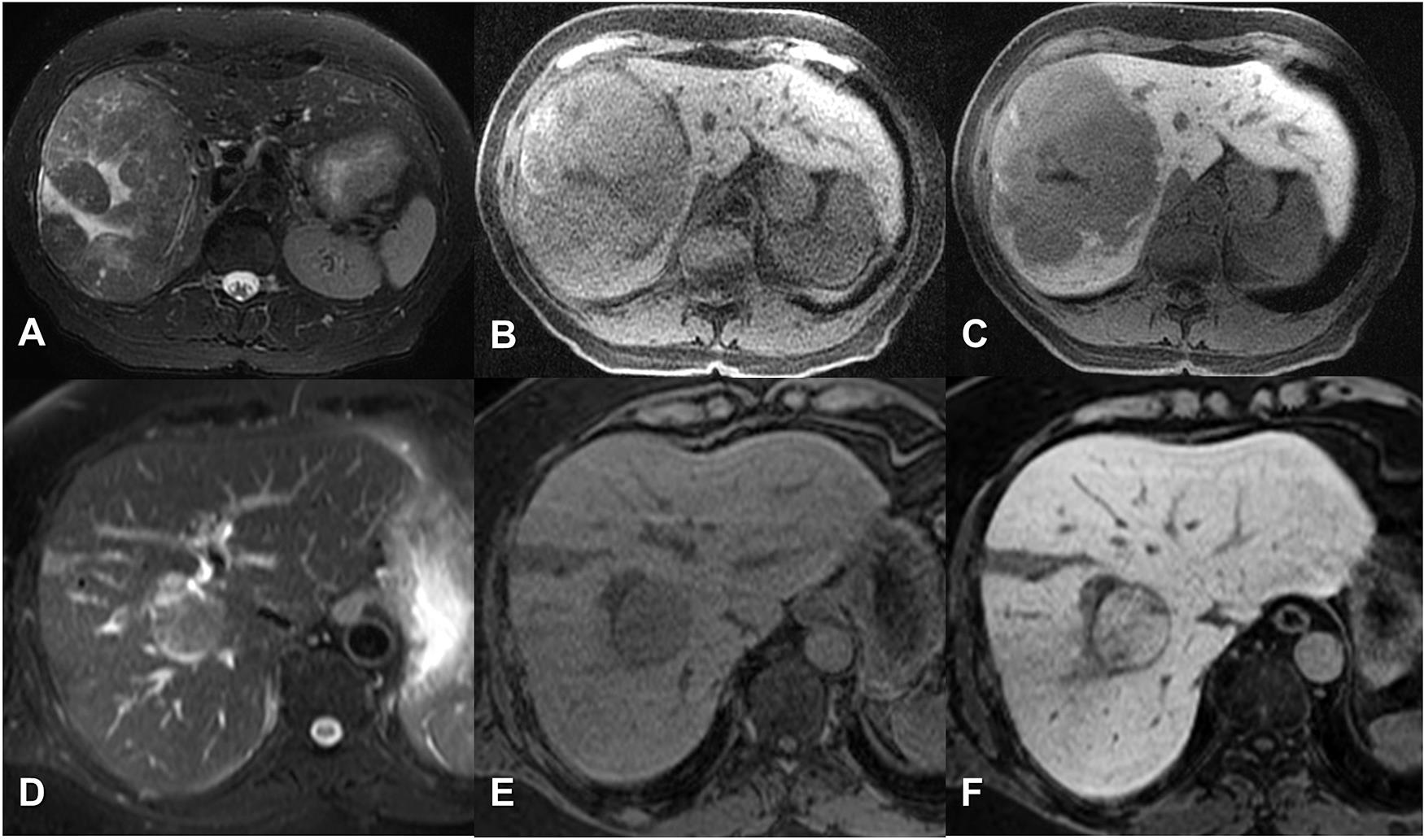 Axial magnetic resonance imaging on a separate patient performed with hepatobiliary contrast agent (gadoxetate) in two separate patients.